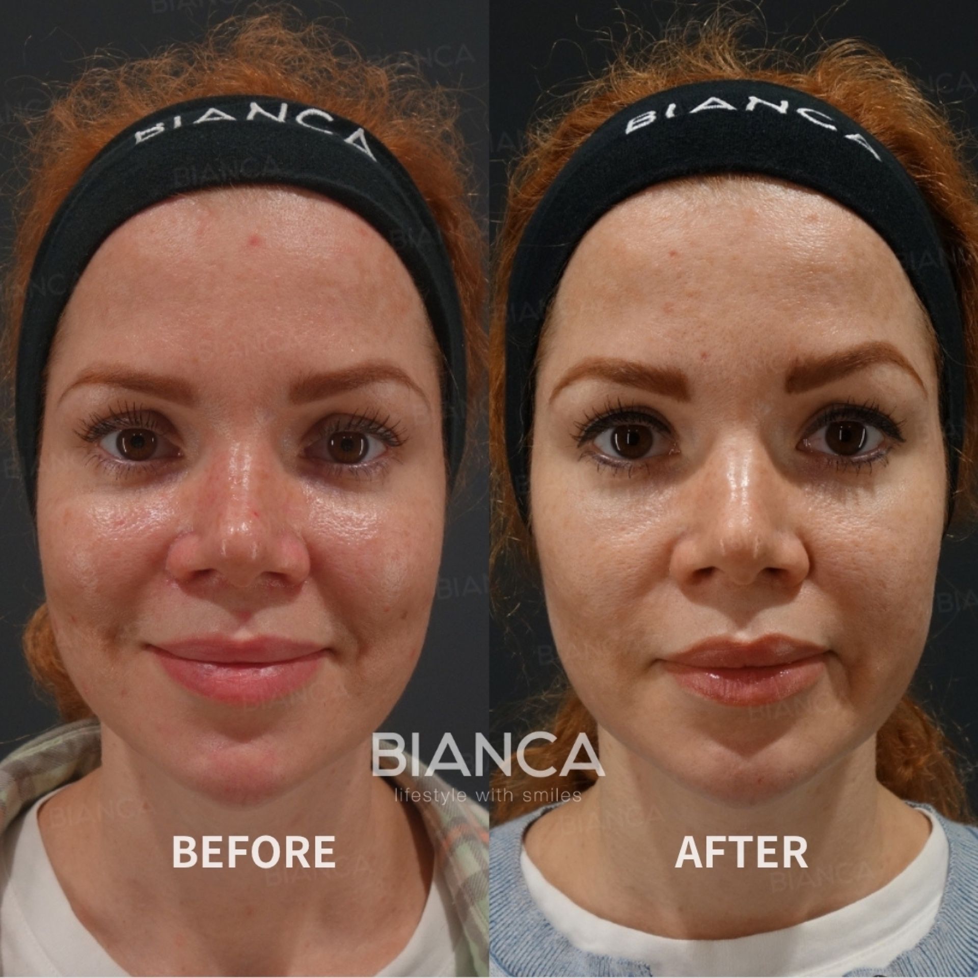 Pico laser spot removal before and after full face treatment, front view, photographed once the crusts had cleared at 2 weeks