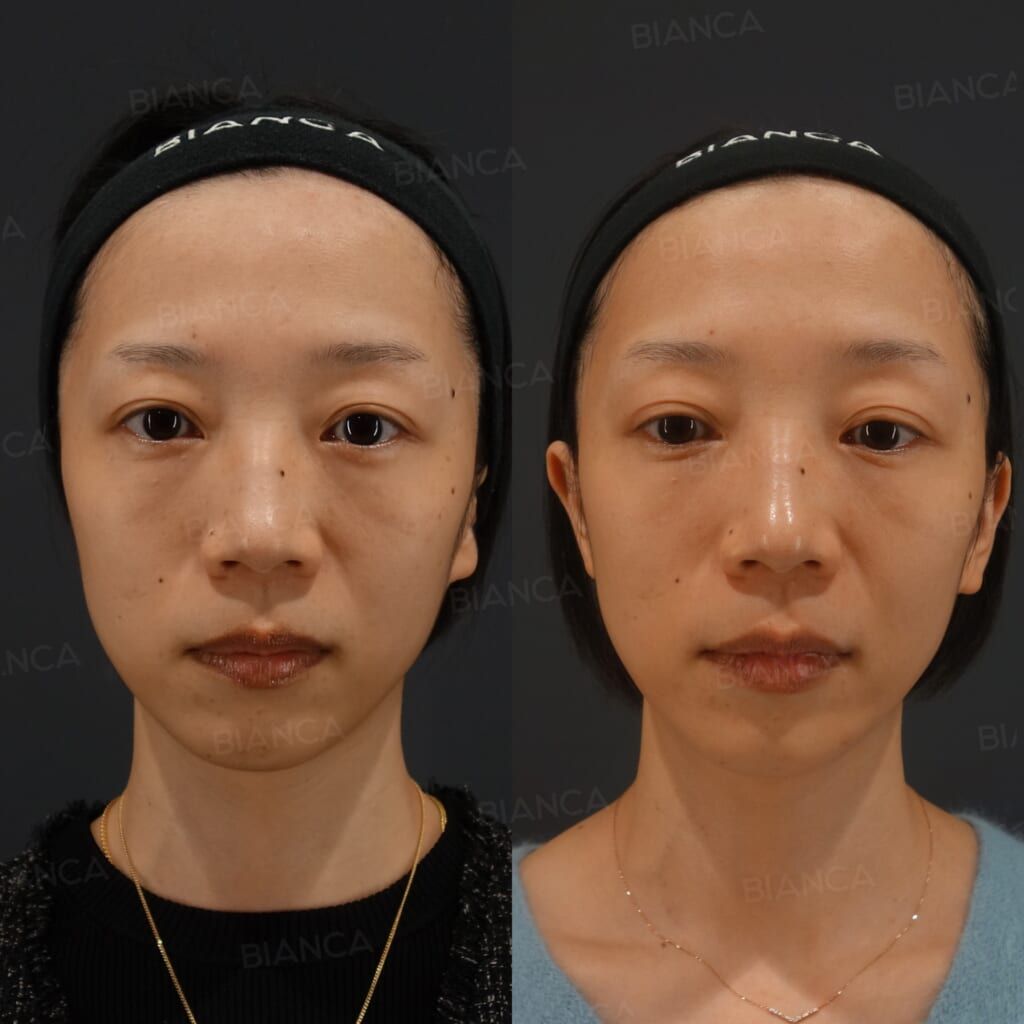 Pico Spot (Full Face)
