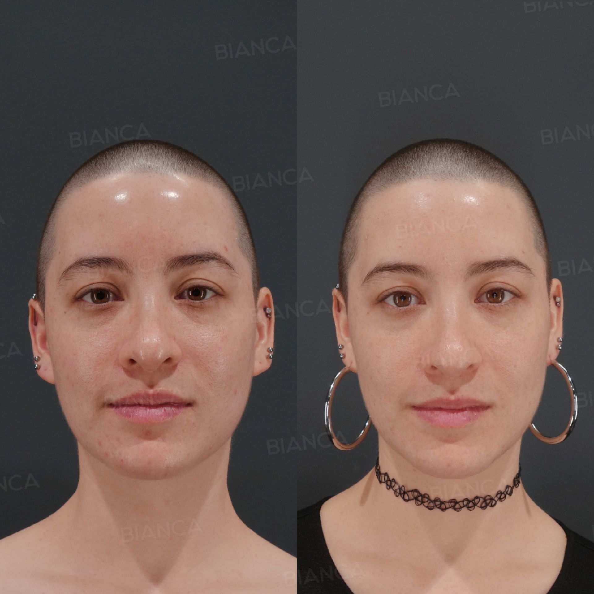 Pico laser spot removal before and after full face treatment of individual pigmented spots, front view, at 1 month
