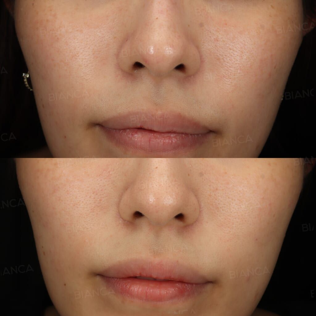 Pico Spot (Full Face)