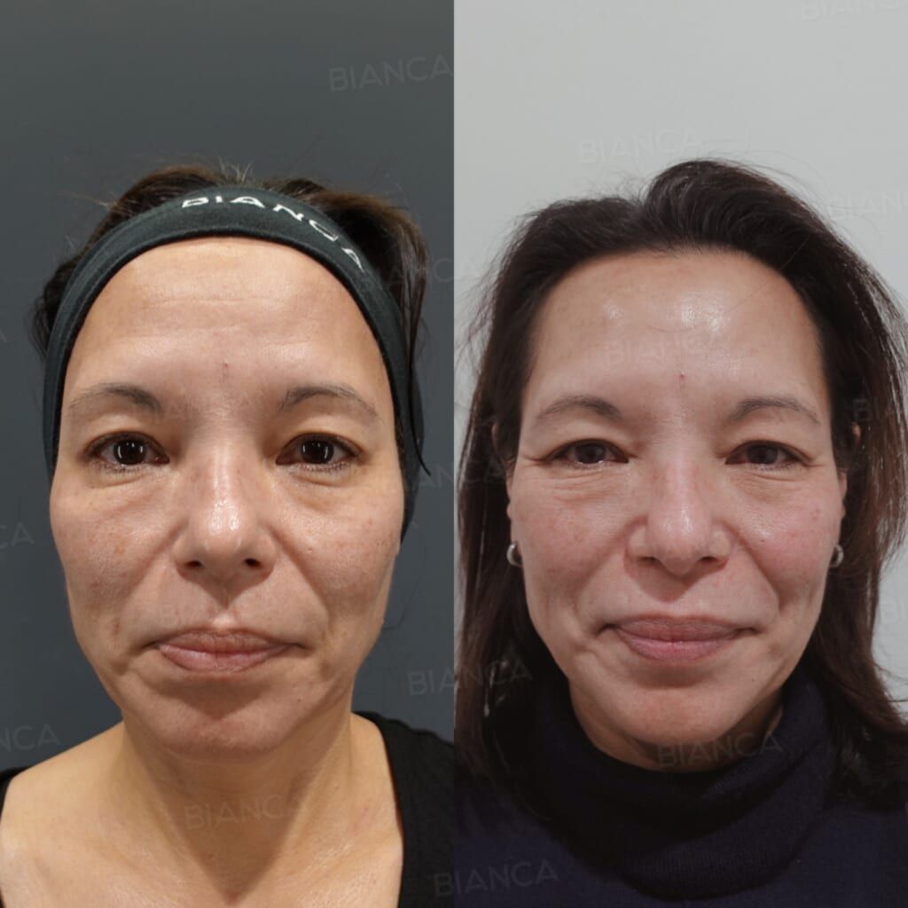 Pico Toning (Face), Sunekos