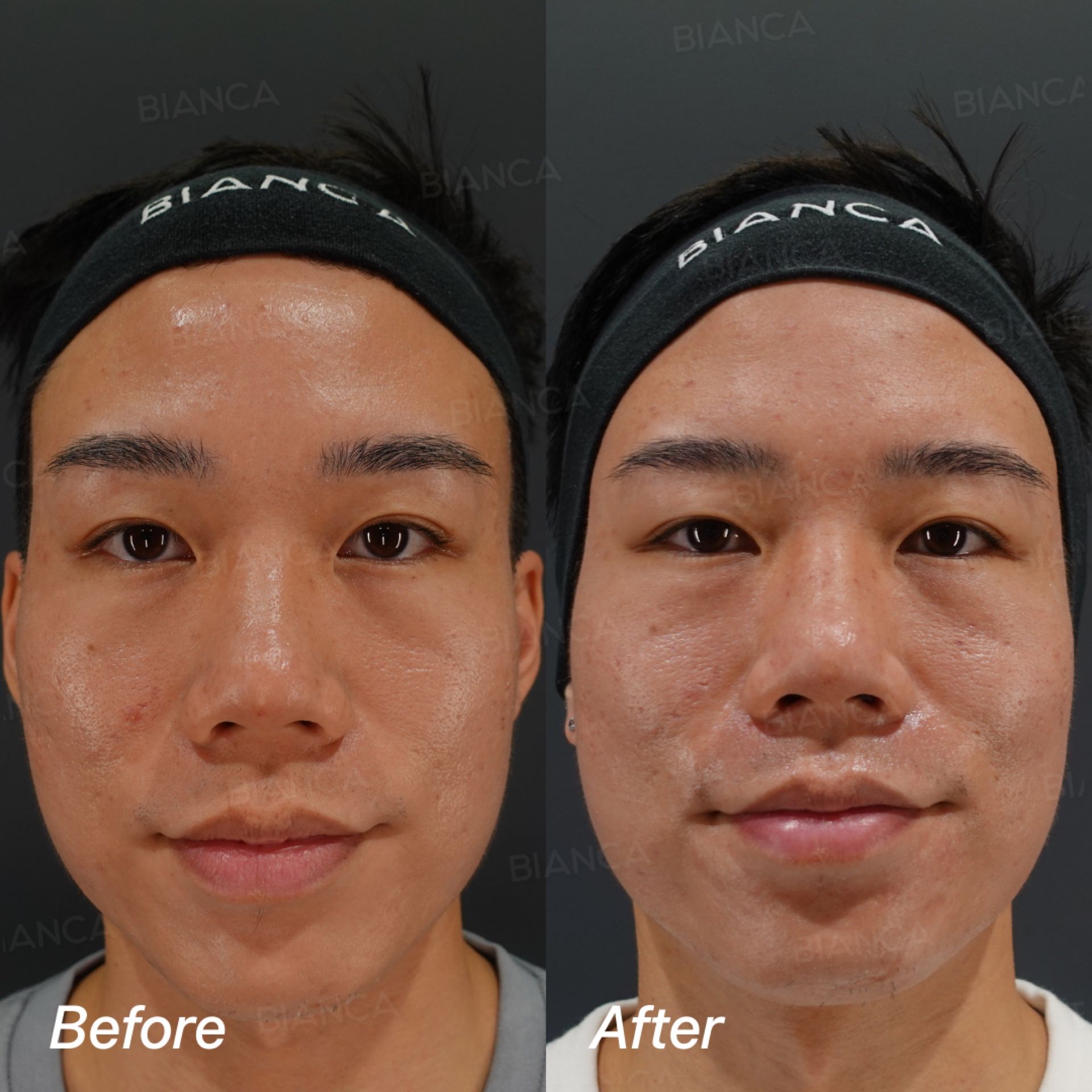 Rejuran skin healer before and after full face POTENZA radiofrequency microneedling and Rejuran injection, front view at 2 weeks