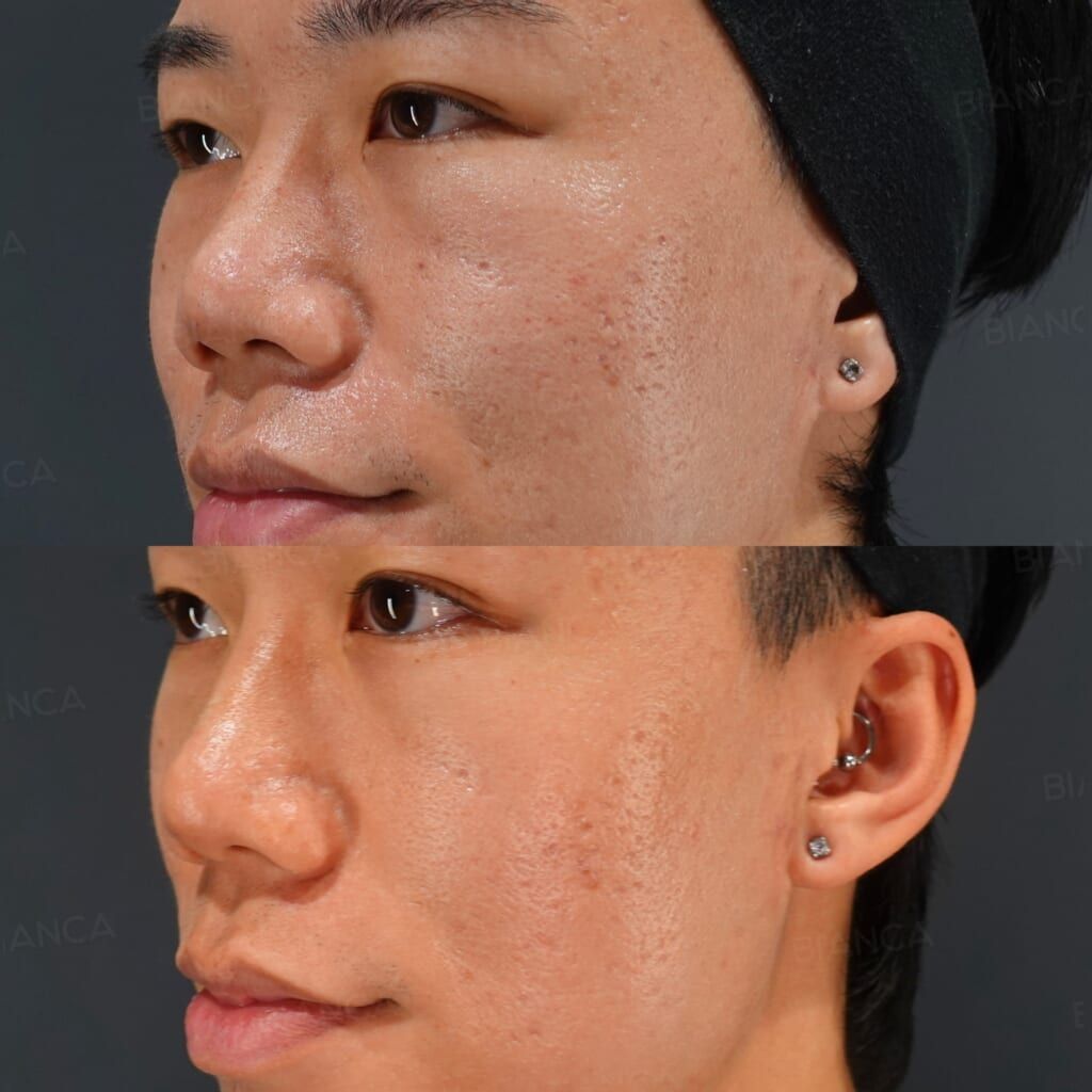 POTENZA, Rejuran (Full Face)
