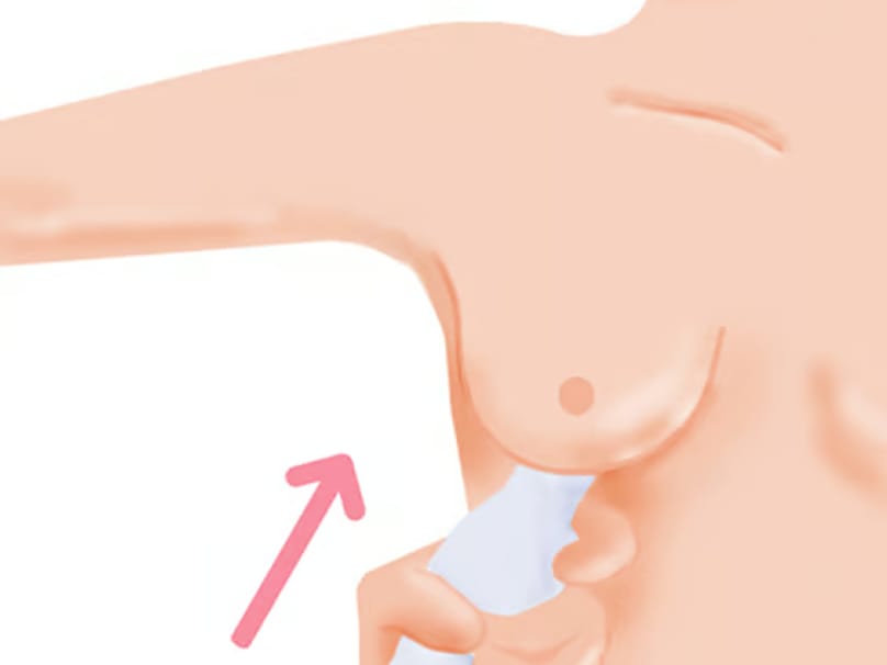 Diagram of Preservé breast augmentation showing tissue-preserving implant insertion technique
