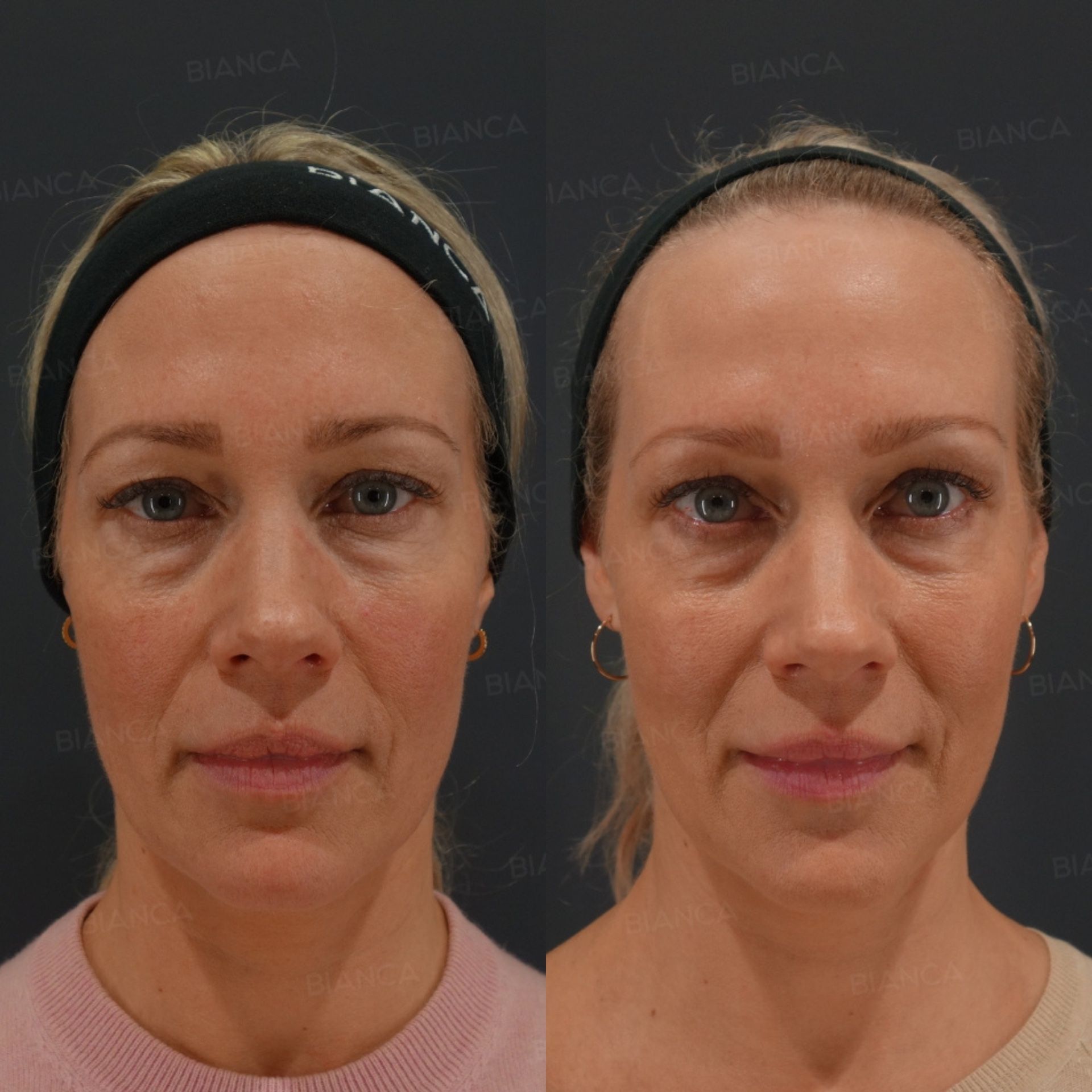 Profhilo before and after skin booster injections at set points for hydration and firmness, front view of the face, at 1 month