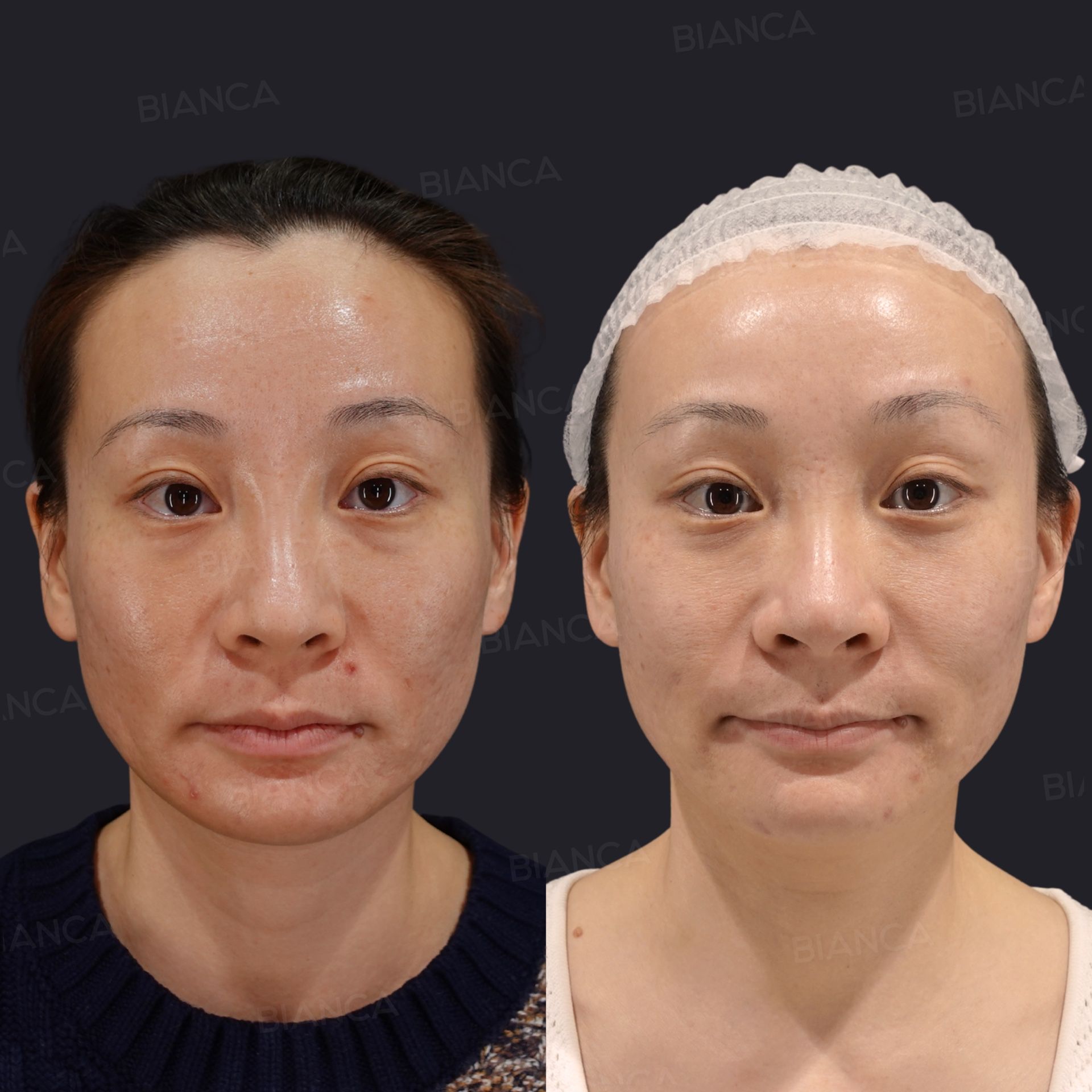 PRP (Platelet Rich Plasma)