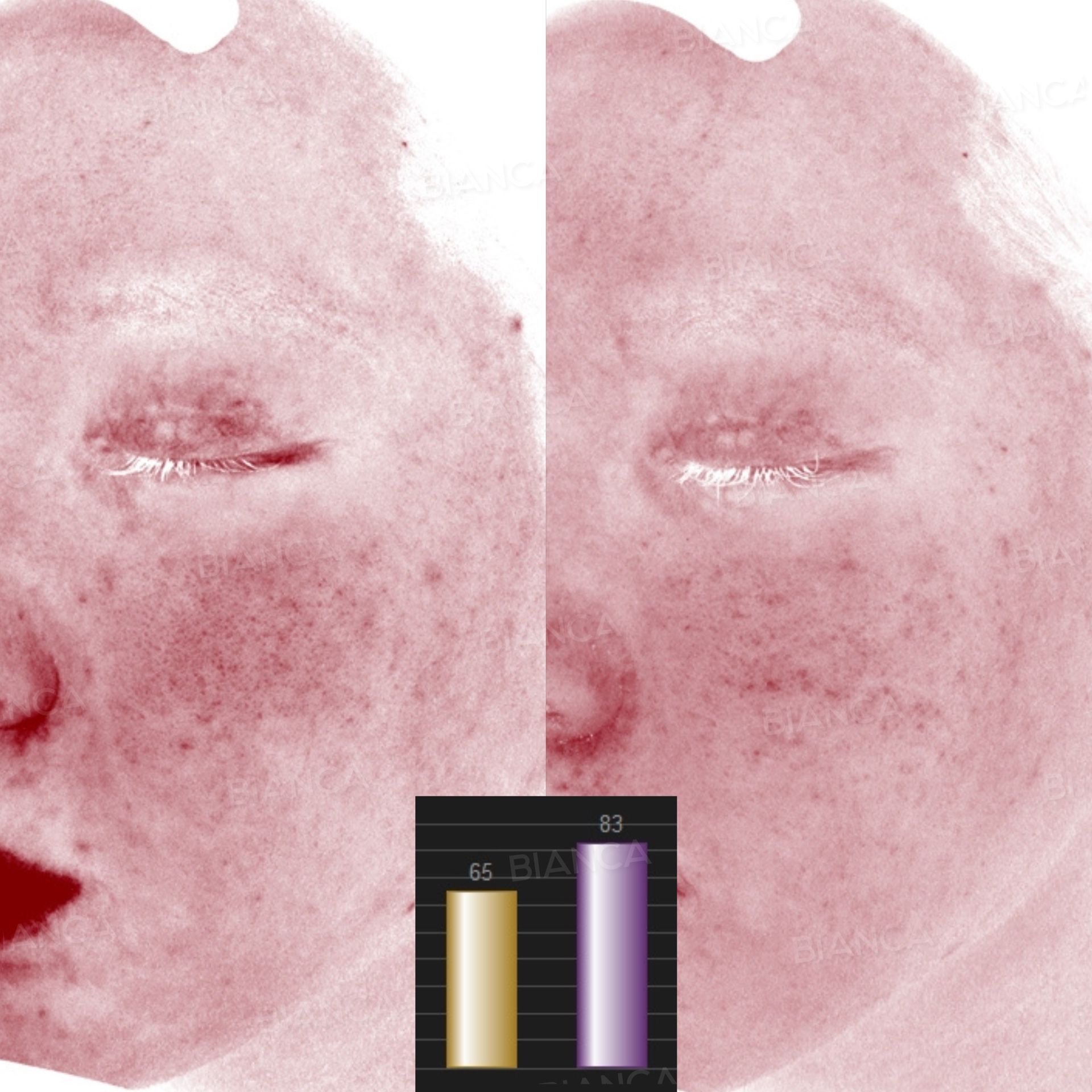 Skin booster before and after Re2O (BNAJU) shown on a red vascular skin analysis map of one half of the face, with scores of 65 and 83, at 4 months