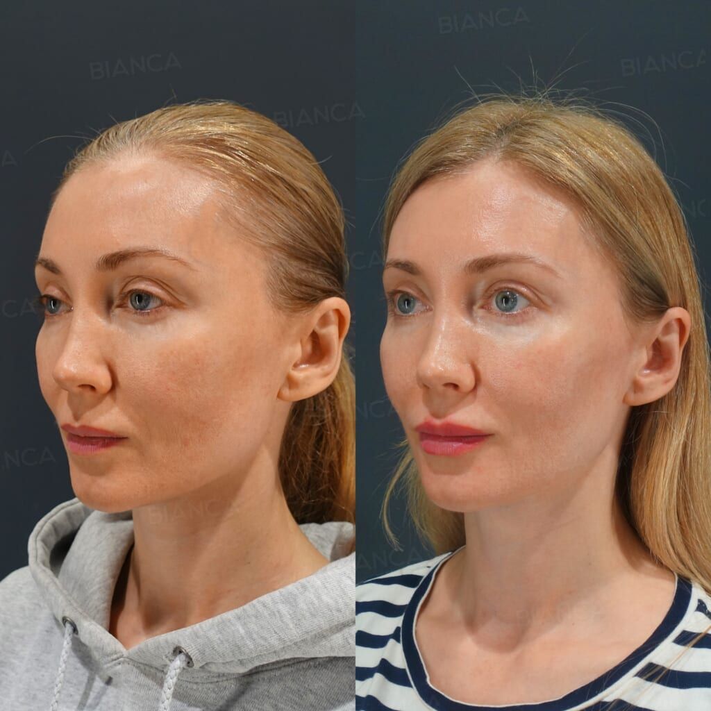 Rejuran i, Hyaluronic Acid Injection (Lips: Juvederm VOLITE / SKINVIVE), Profhilo (Face)
