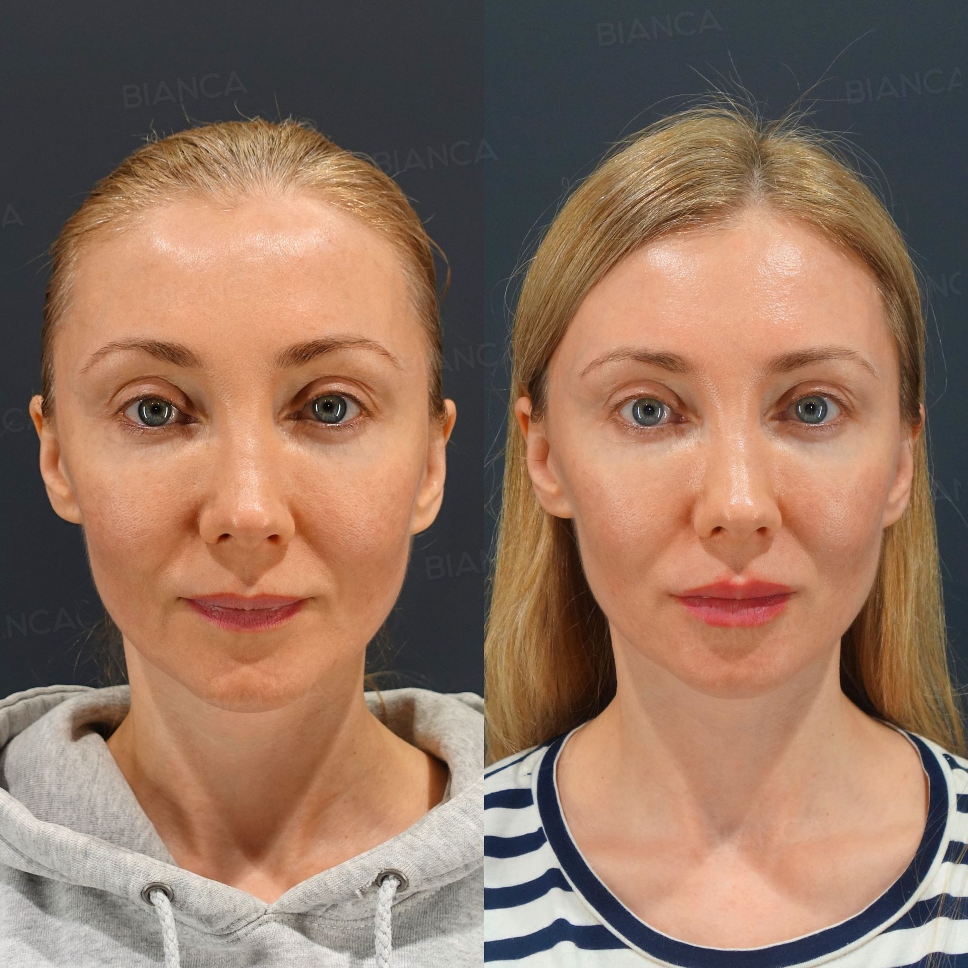 Rejuran i, Hyaluronic Acid Injection (Lips: Juvederm VOLITE / SKINVIVE), Profhilo (Face)