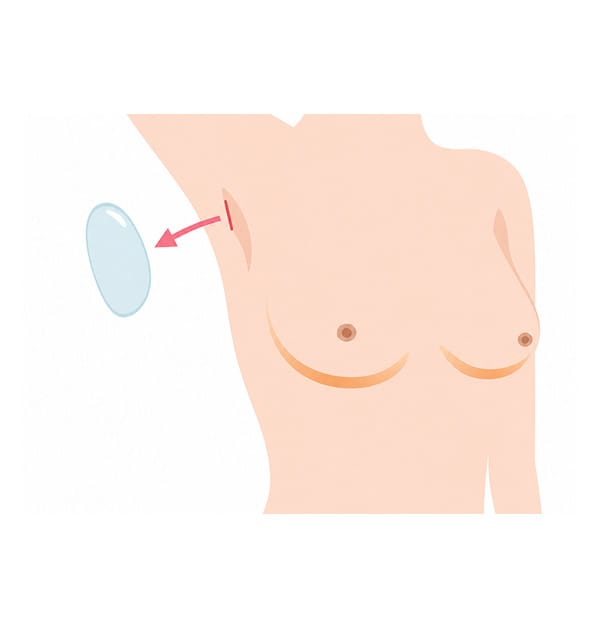 Diagram showing removal of a silicone breast implant through the incision site