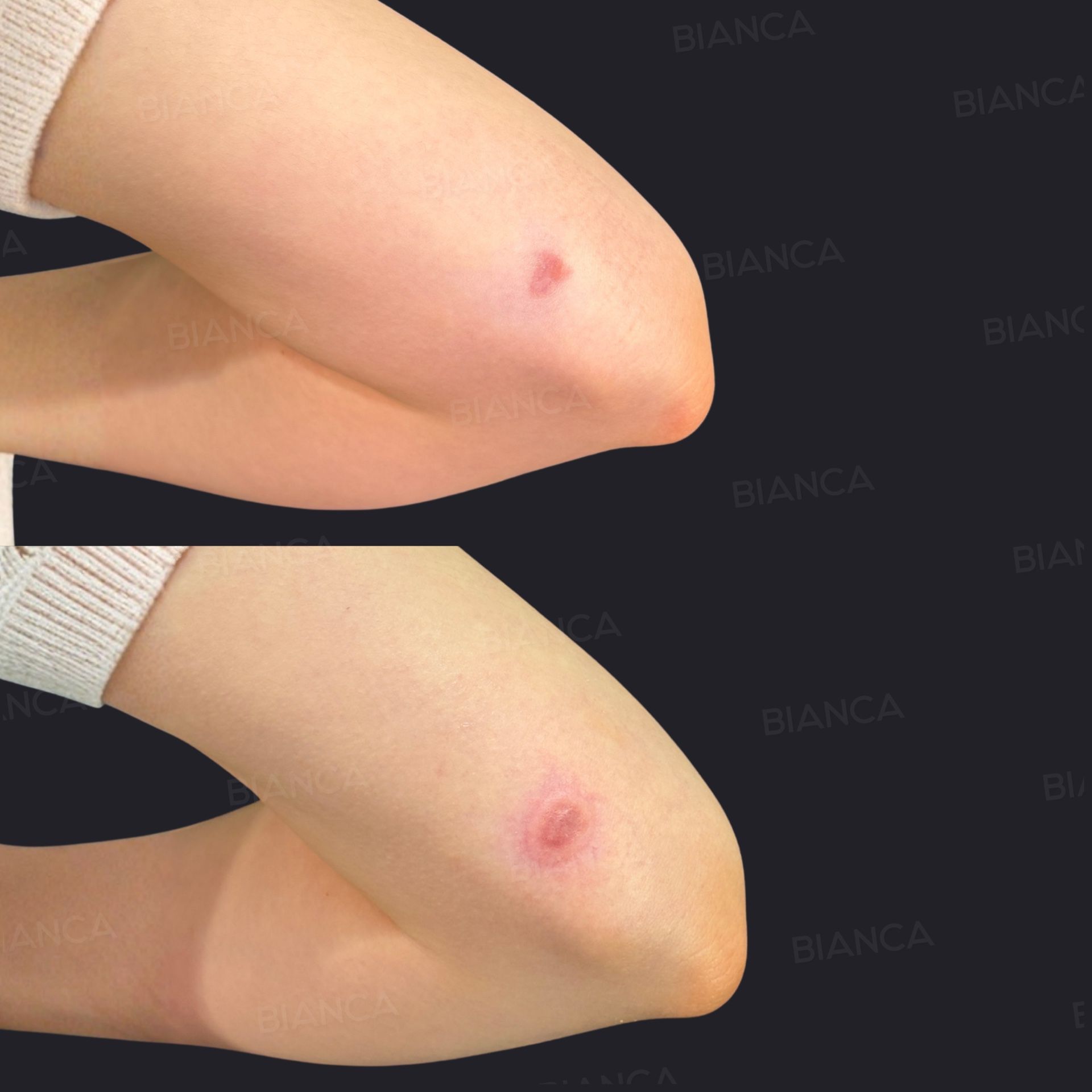 Scar removal before and after scarless revision of a raised scar on the elbow, with the wound closed under redistributed tension, after 3 sessions