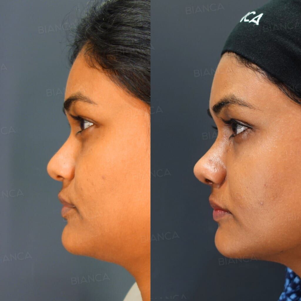 Septal Extension (Septal Cartilage) + Alar Reduction + Nasal Tip Refinement + Nasal Bone Osteotomy & Narrowing