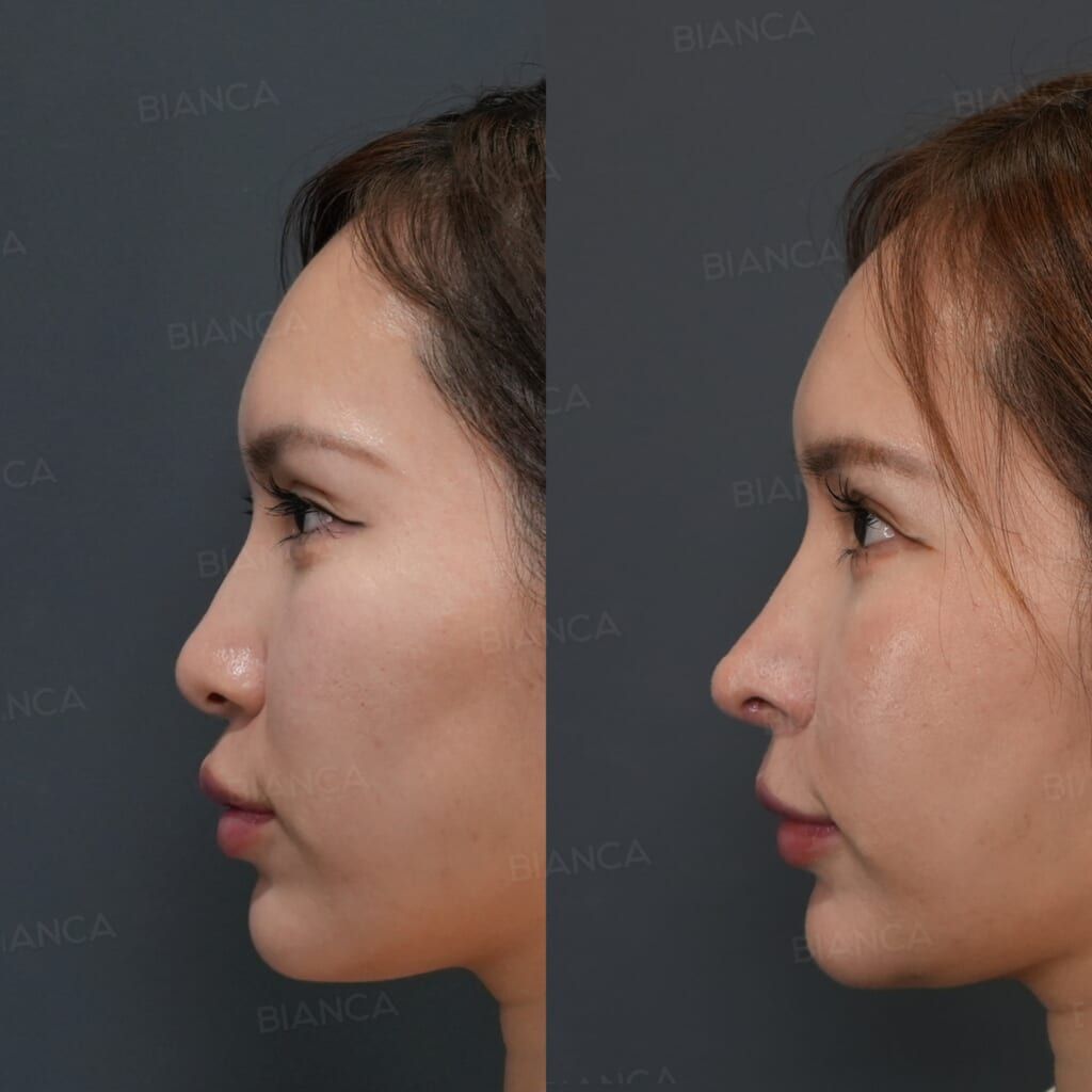 Septal Extension (Rib Cartilage Graft), Alar Base Augmentation (Diced Rib Cartilage), Nasal Tip Plasty