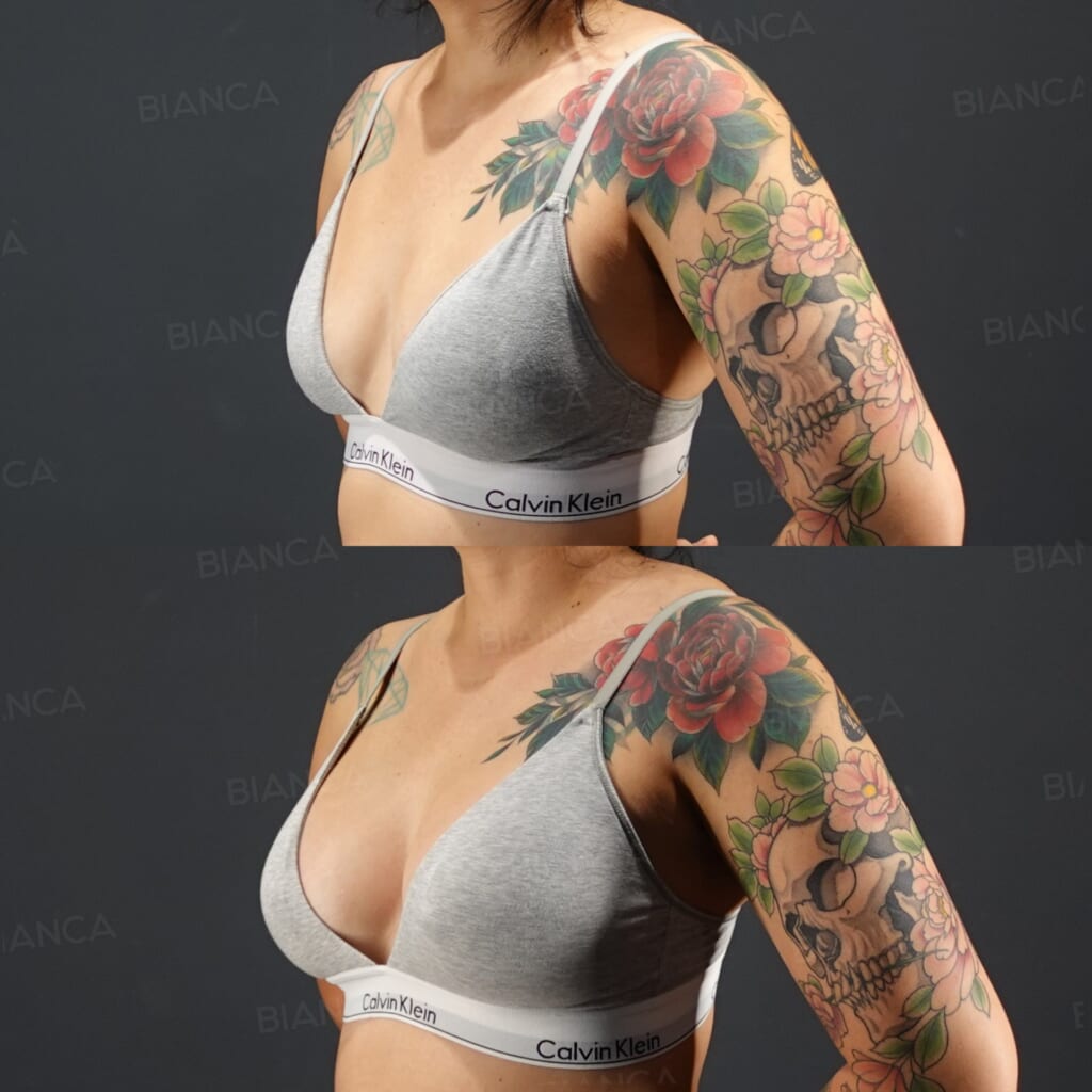Silicone Implant Breast Augmentation before and after, 1 week, BIANCA CLINIC Tokyo