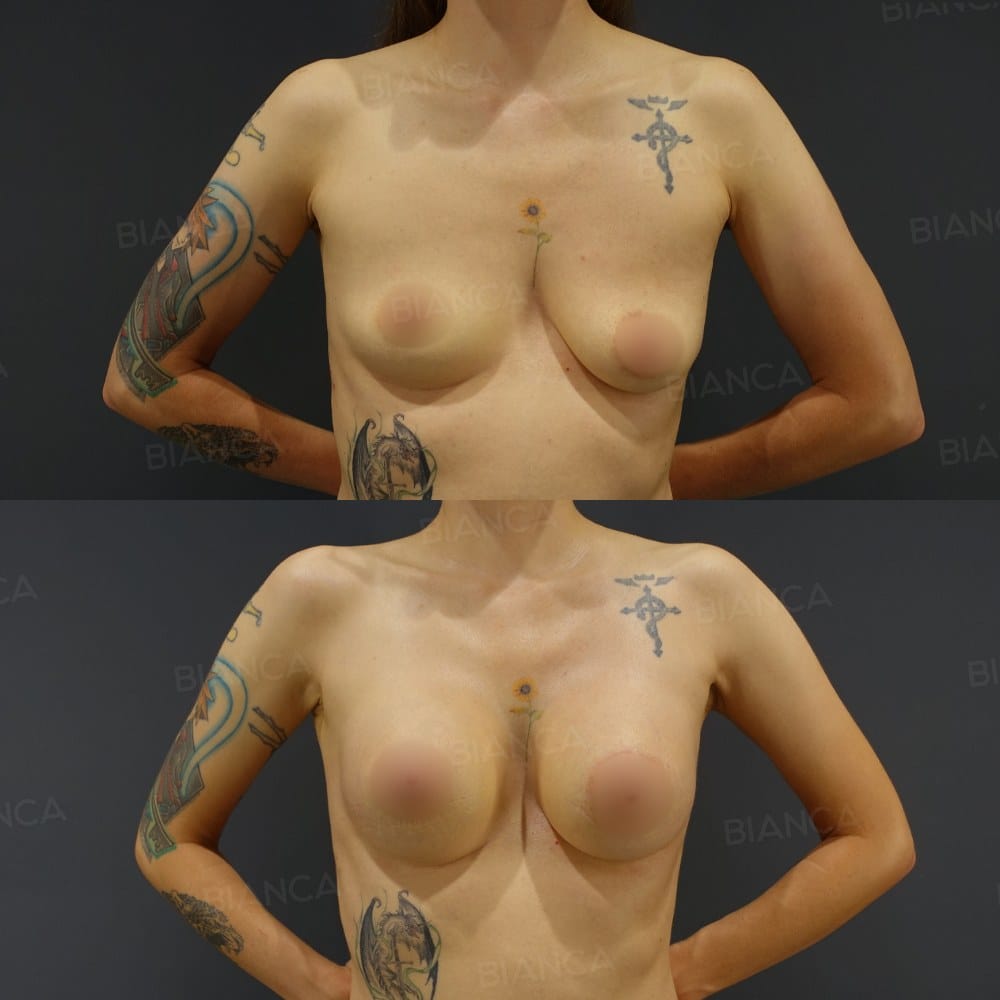 Silicone Implant Breast Augmentation before and after, 1 month, BIANCA CLINIC Tokyo