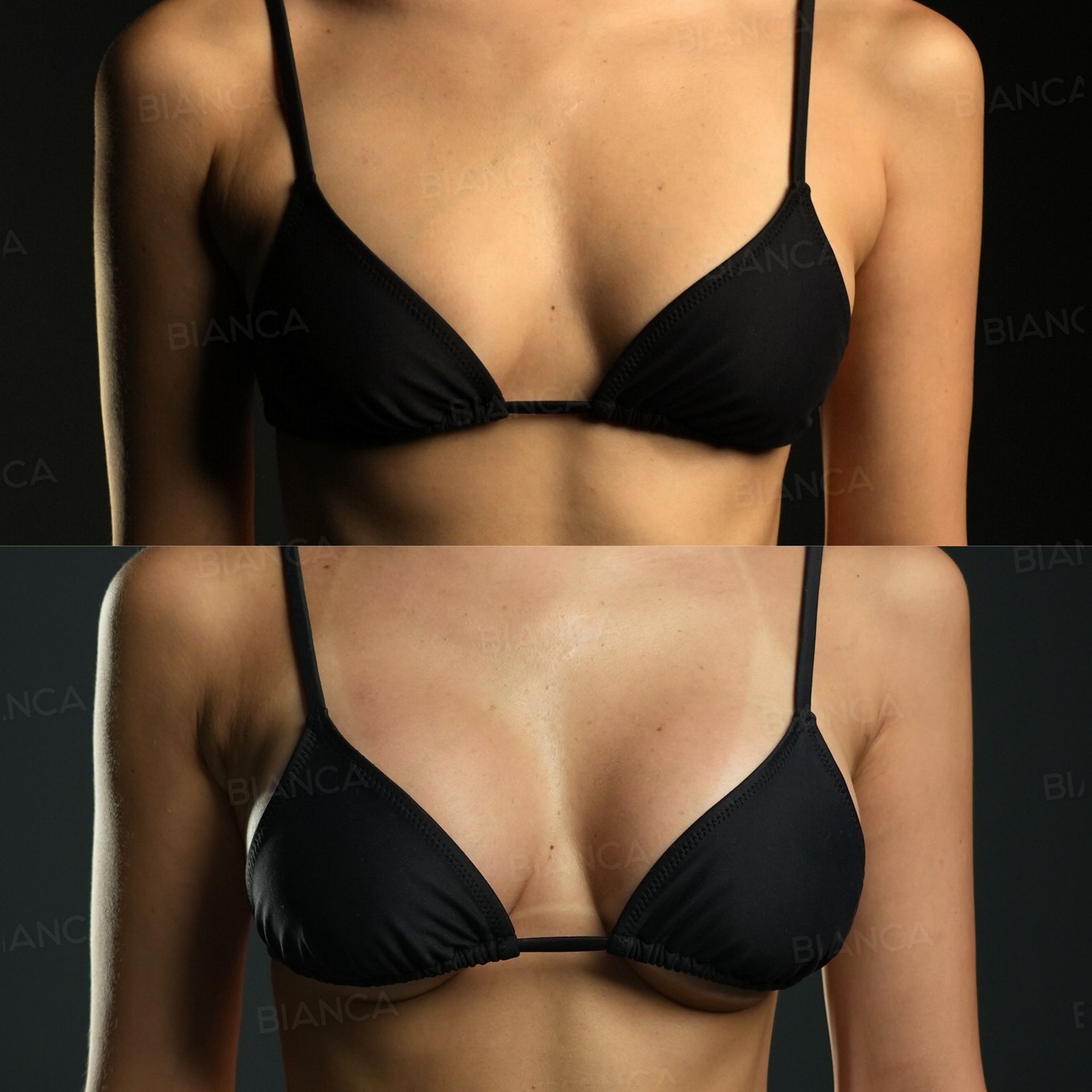 Silicone Implant Breast Augmentation (Motiva, 185 cc)