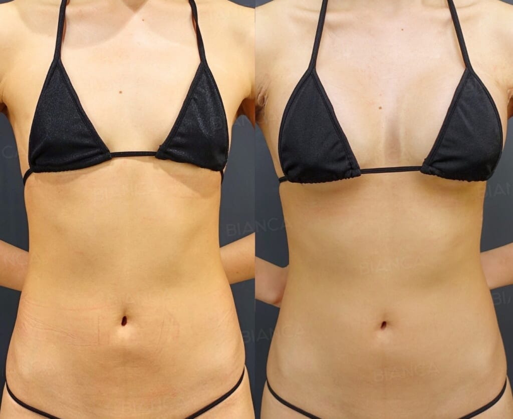 Silicone Implant Breast Augmentation (Motiva Ergonomix2, 270 cc)