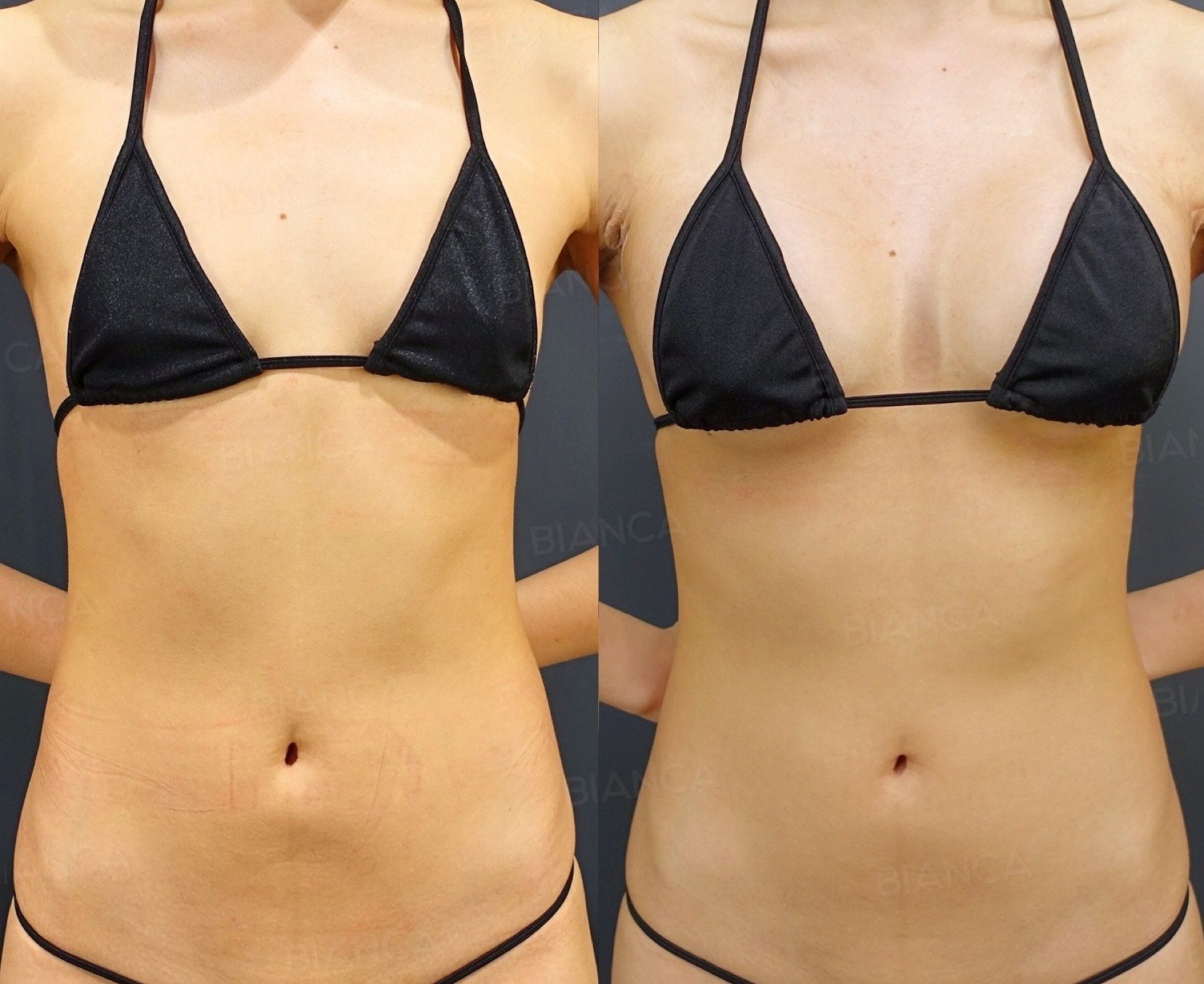 Silicone Implant Breast Augmentation (Motiva Ergonomix2, 270 cc)