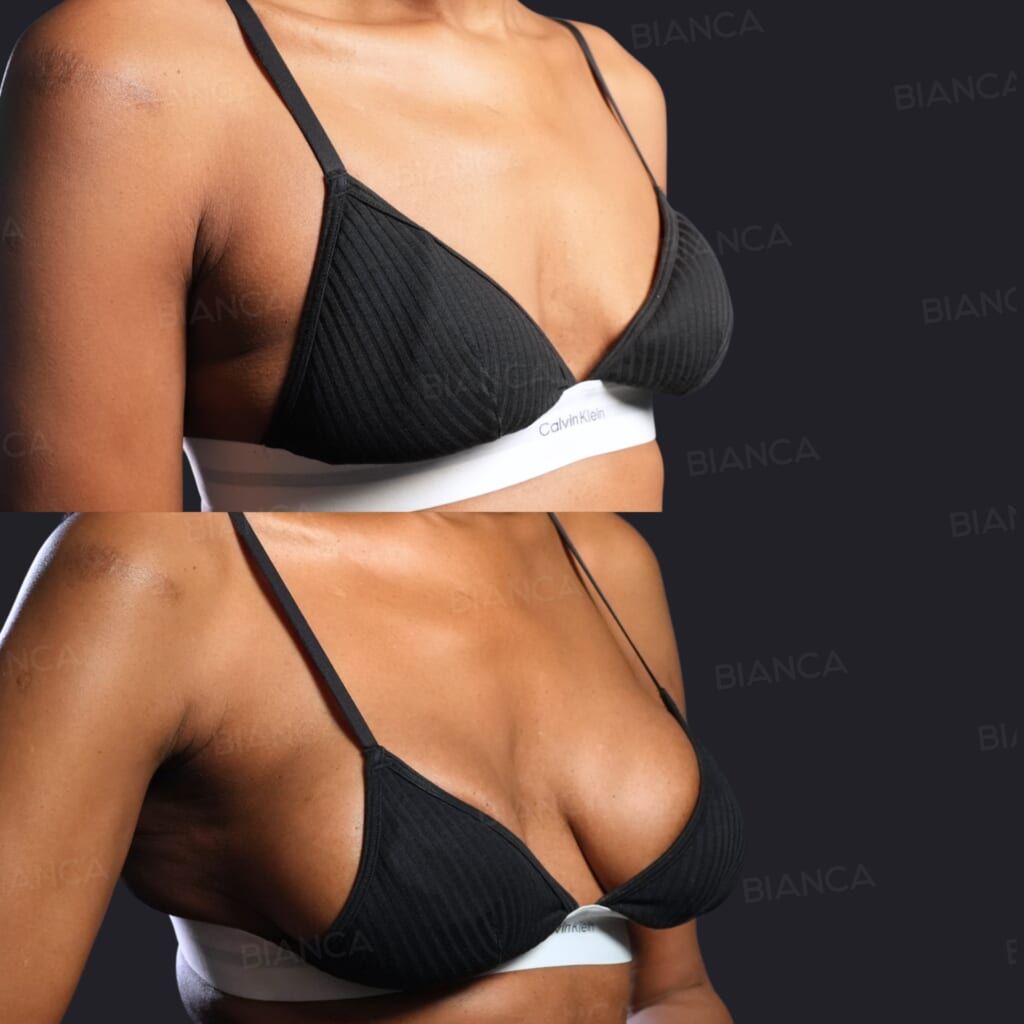Silicone Implant Breast Augmentation (Preserve, 330 cc)