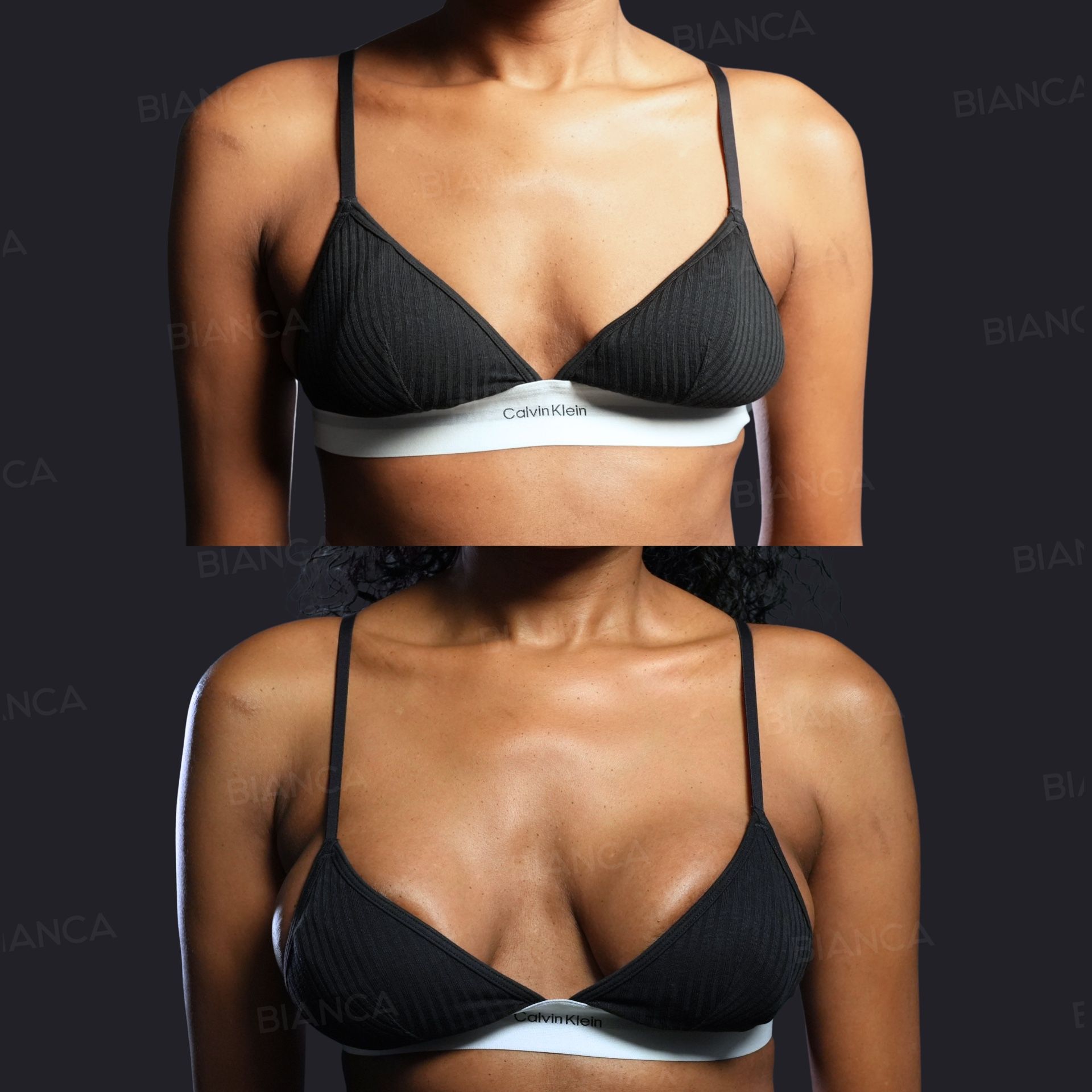 Breast augmentation before and after placement of a 330 cc Preserve silicone implant, front view, at 3 months
