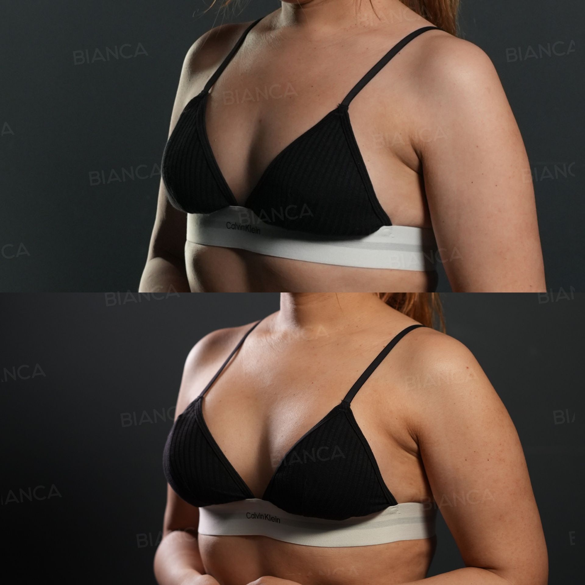 Breast augmentation before and after placement of a 195 cc Preserve DEMI silicone implant at 3 months