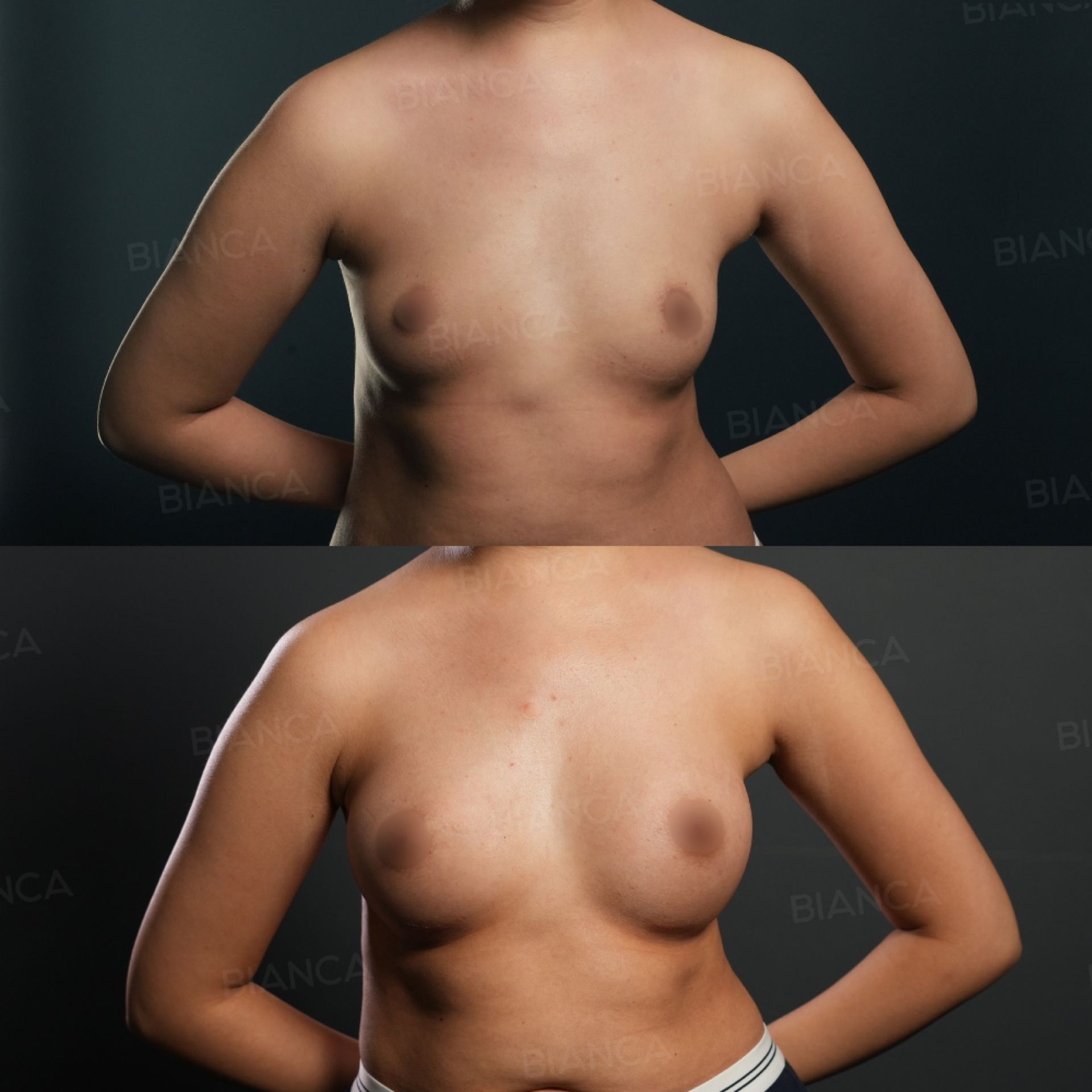 Breast augmentation before and after placement of a 210 cc Preserve DEMI silicone implant at 2 months