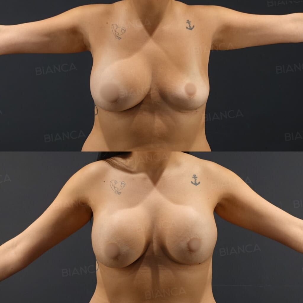 Silicone Implant Removal, Silicone Implant Breast Augmentation (Motiva FULL 400 cc)