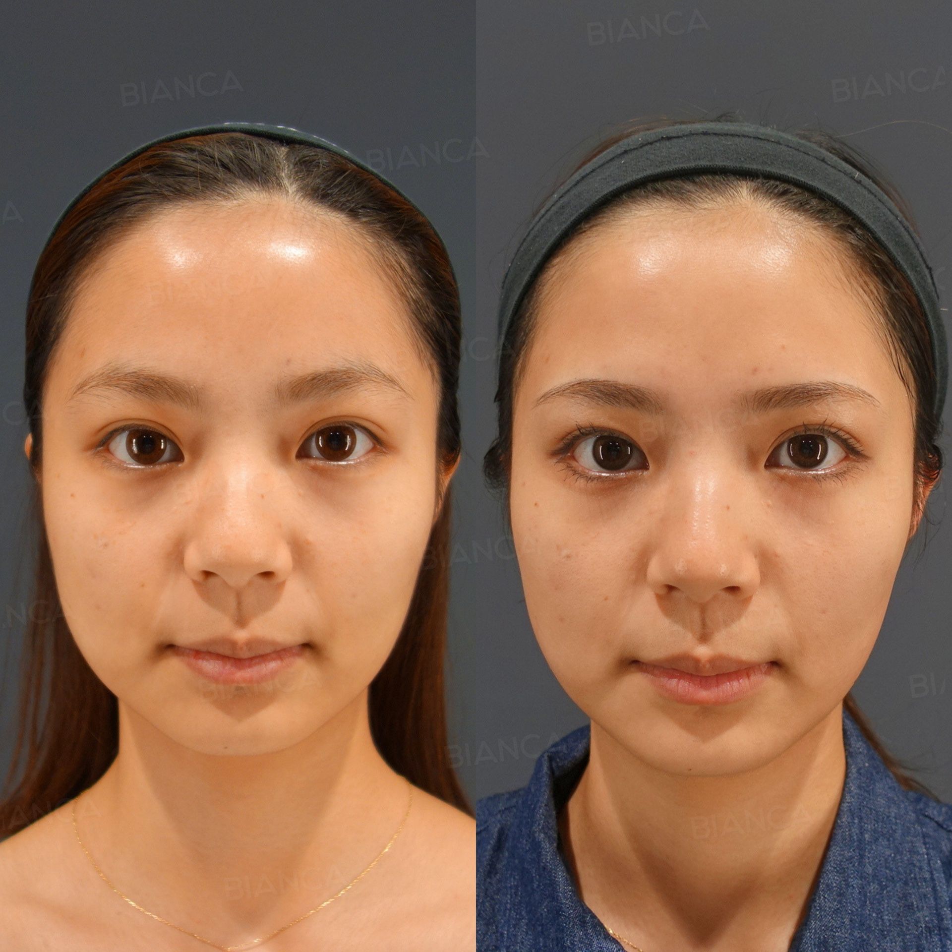 Hydroboost injection before and after hydrating agents, botulinum toxin and exosomes delivered across the full face, front view at 1 month