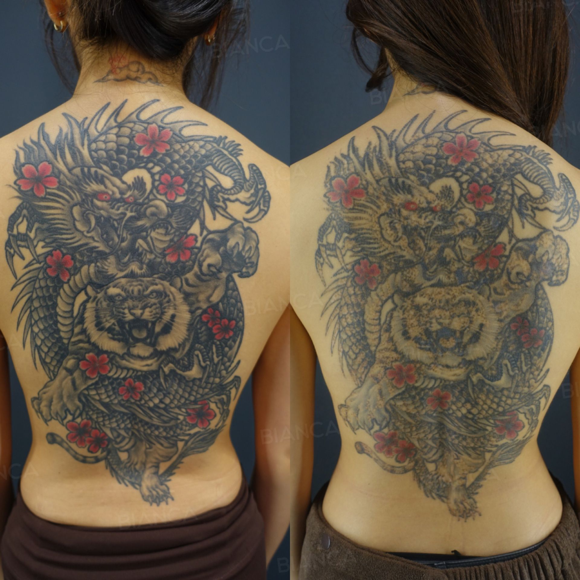 Laser tattoo removal before and after the first session on a large tattoo across the back at 3 months