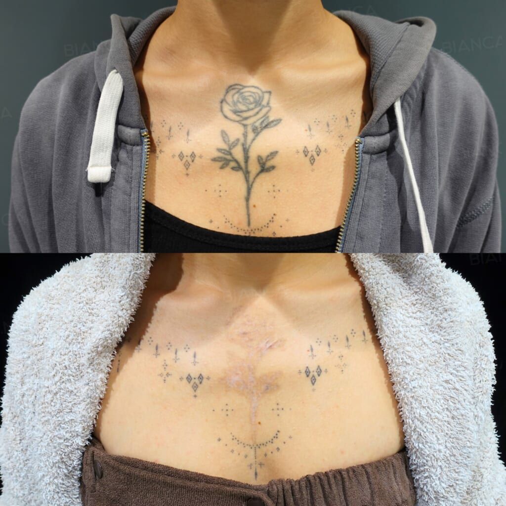 Tattoo Removal (Central Chest)