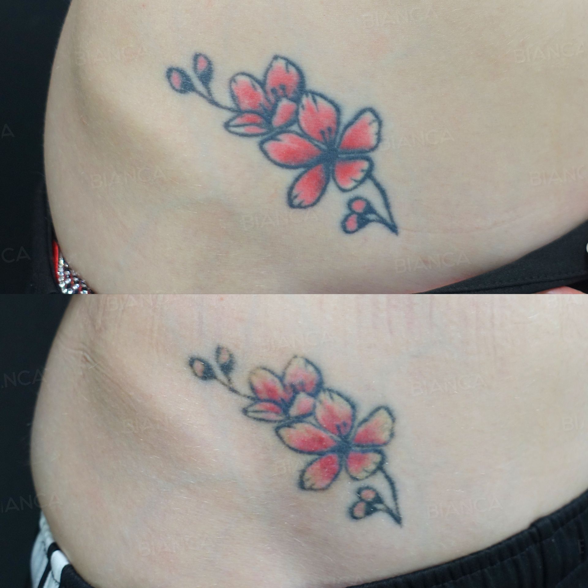 Laser tattoo removal before and after staged treatment of a tattoo on the hip with settings matched to the ink colours at 2 months