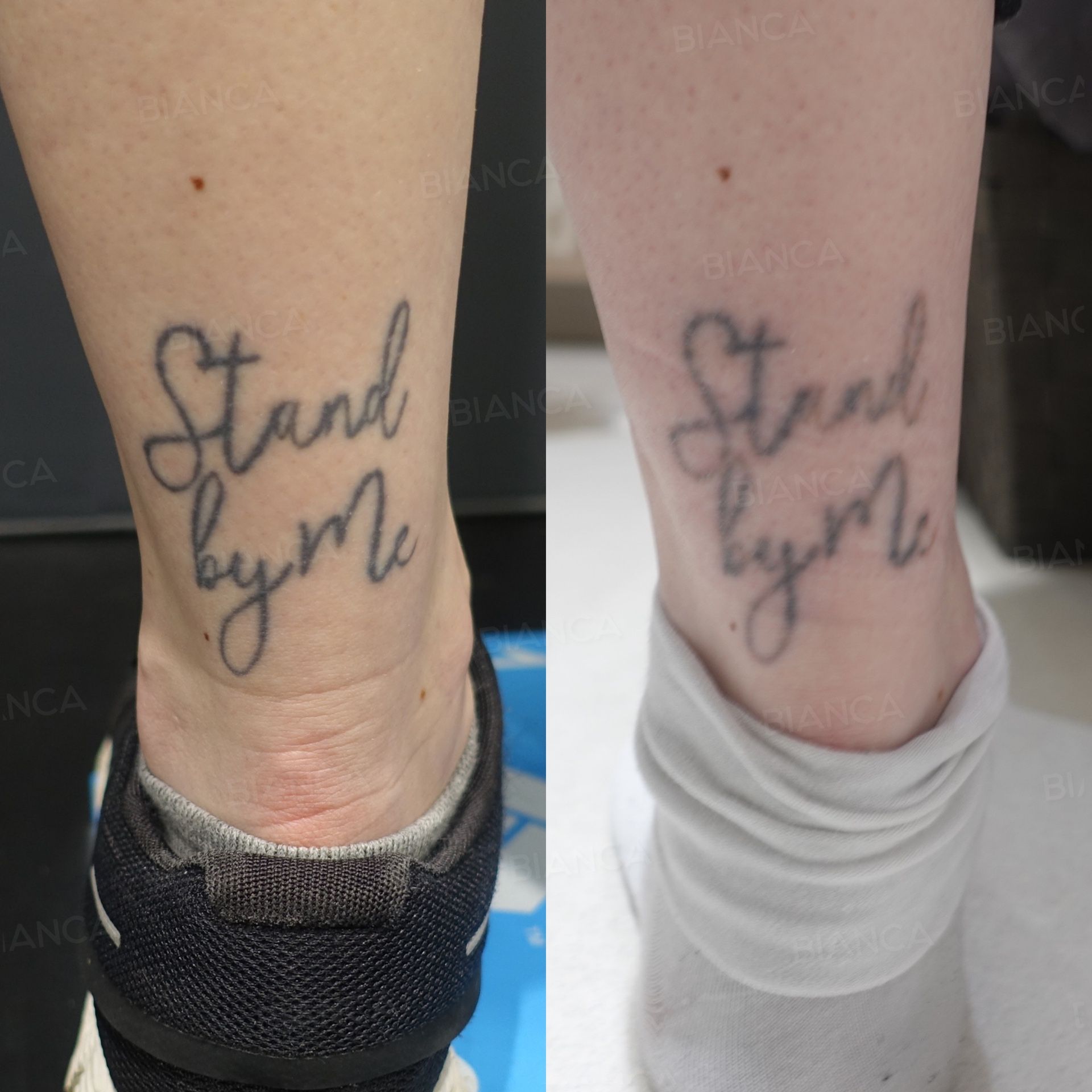 Laser tattoo removal before and after picosecond laser sessions on a tattoo on the left ankle at 2 months