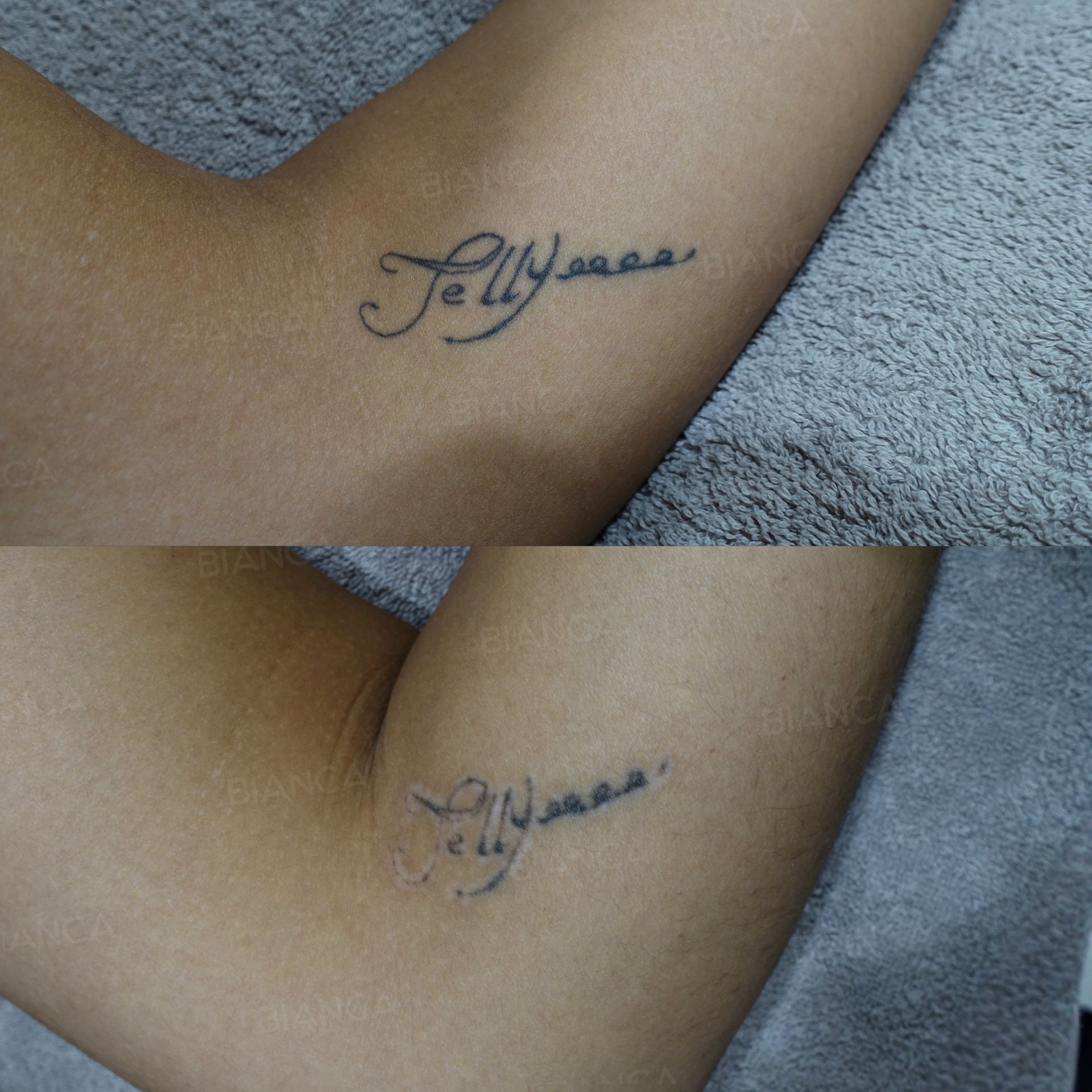 Laser tattoo removal before and after treatment of a coloured tattoo on the left forearm at 2 months