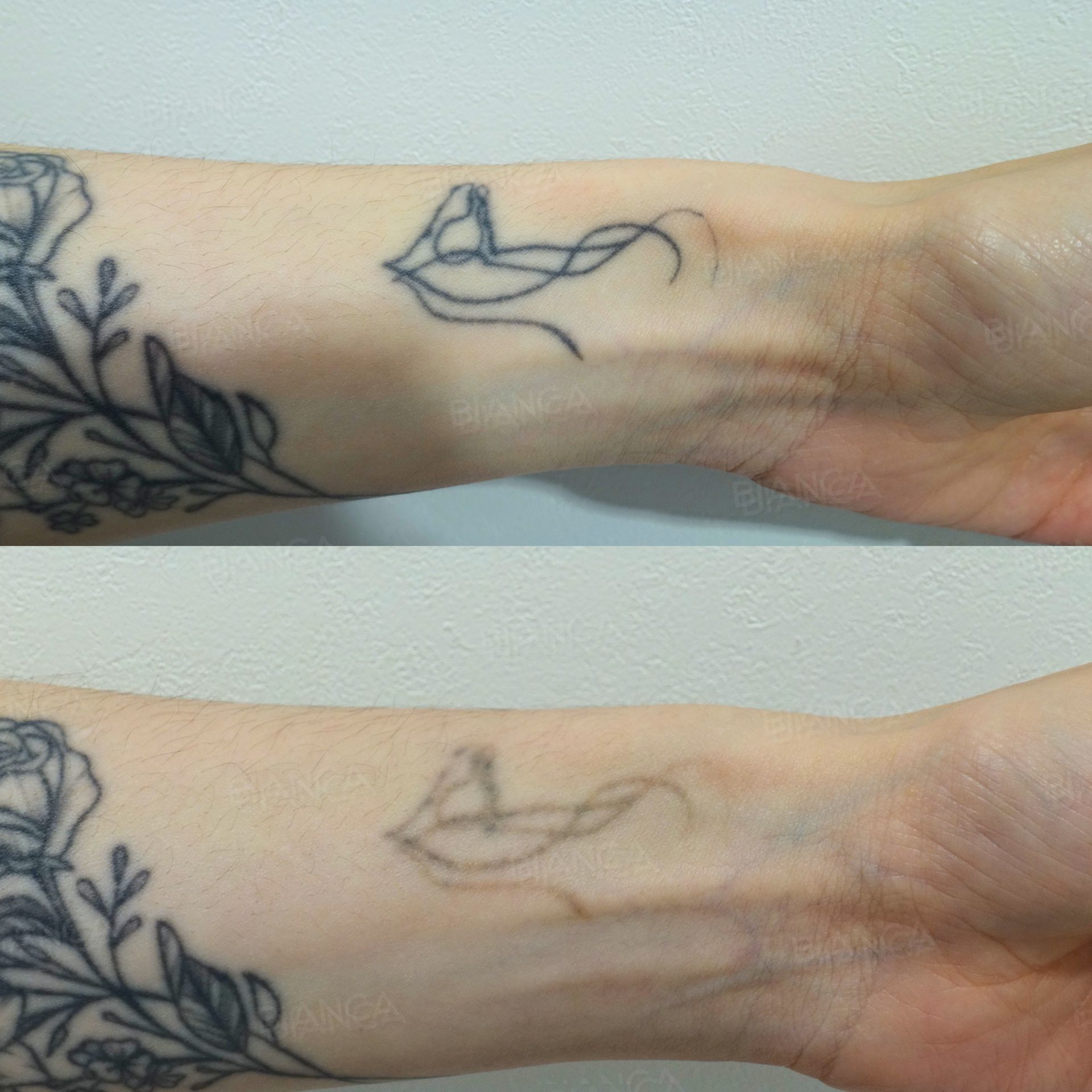 Laser tattoo removal before and after ink on the left wrist beginning to lighten after 2 sessions