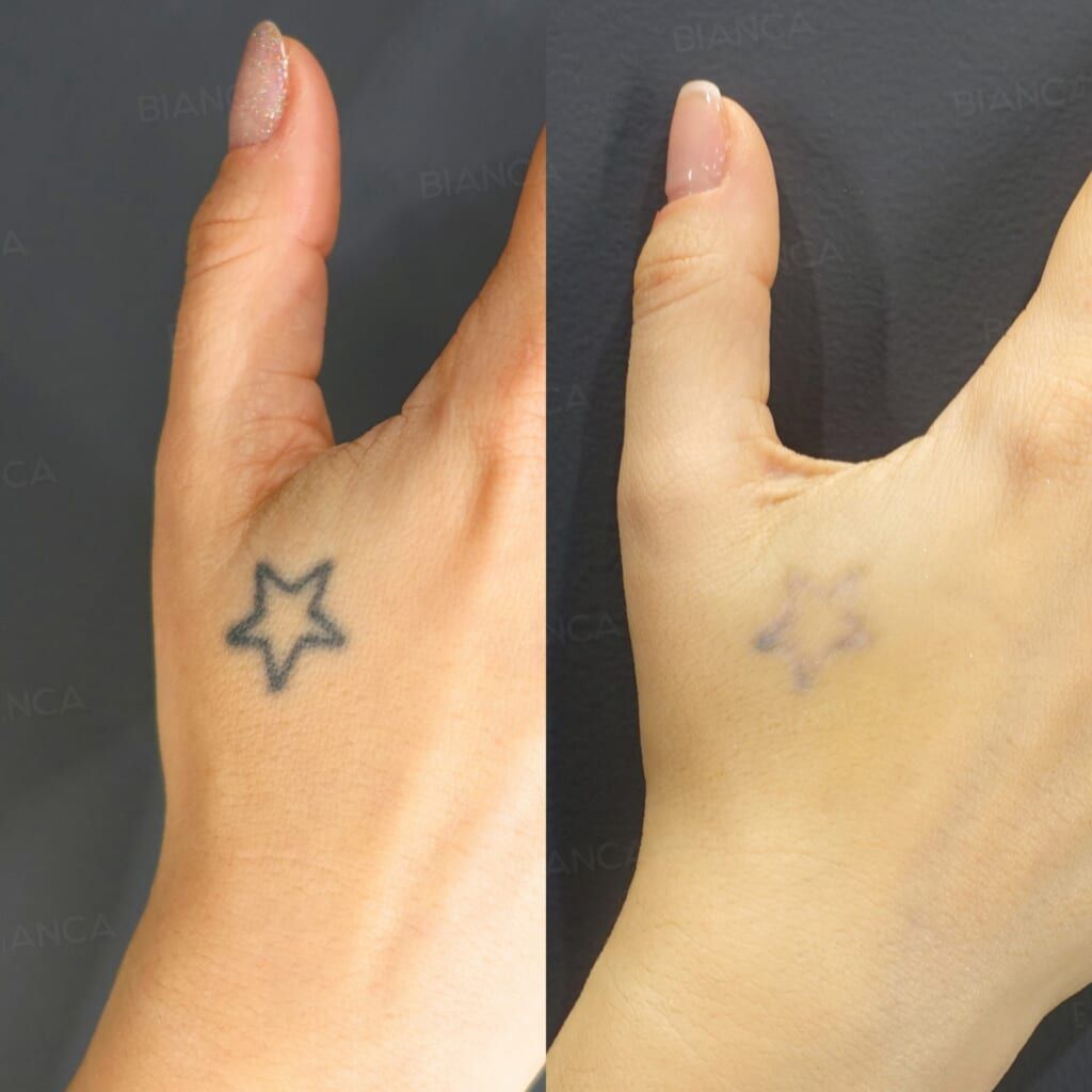 Tattoo Removal (Right Dorsal Hand)