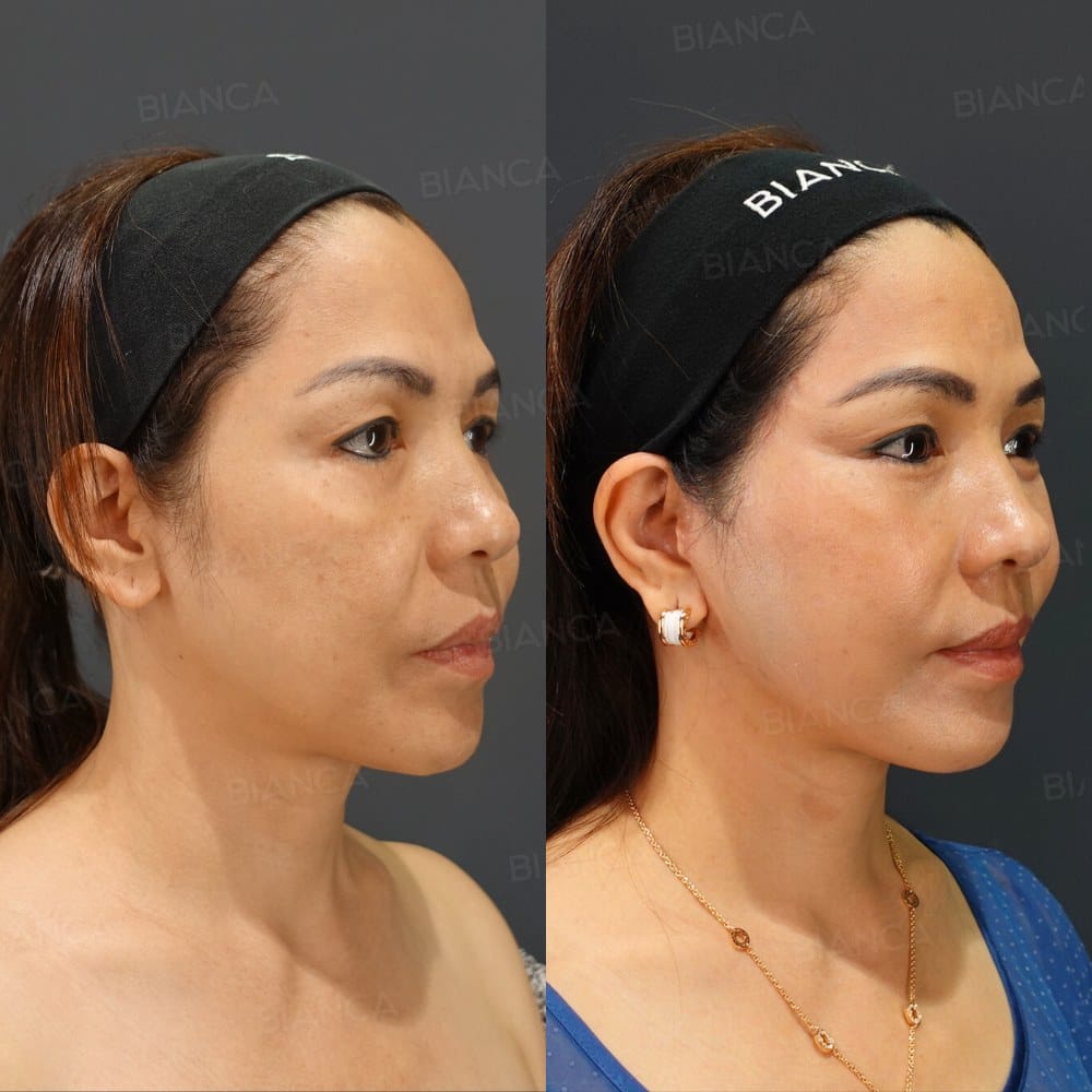 Temporal Lift + Deep Plane Facelift + Platysmaplasty before and after, 3 months, BIANCA CLINIC Tokyo