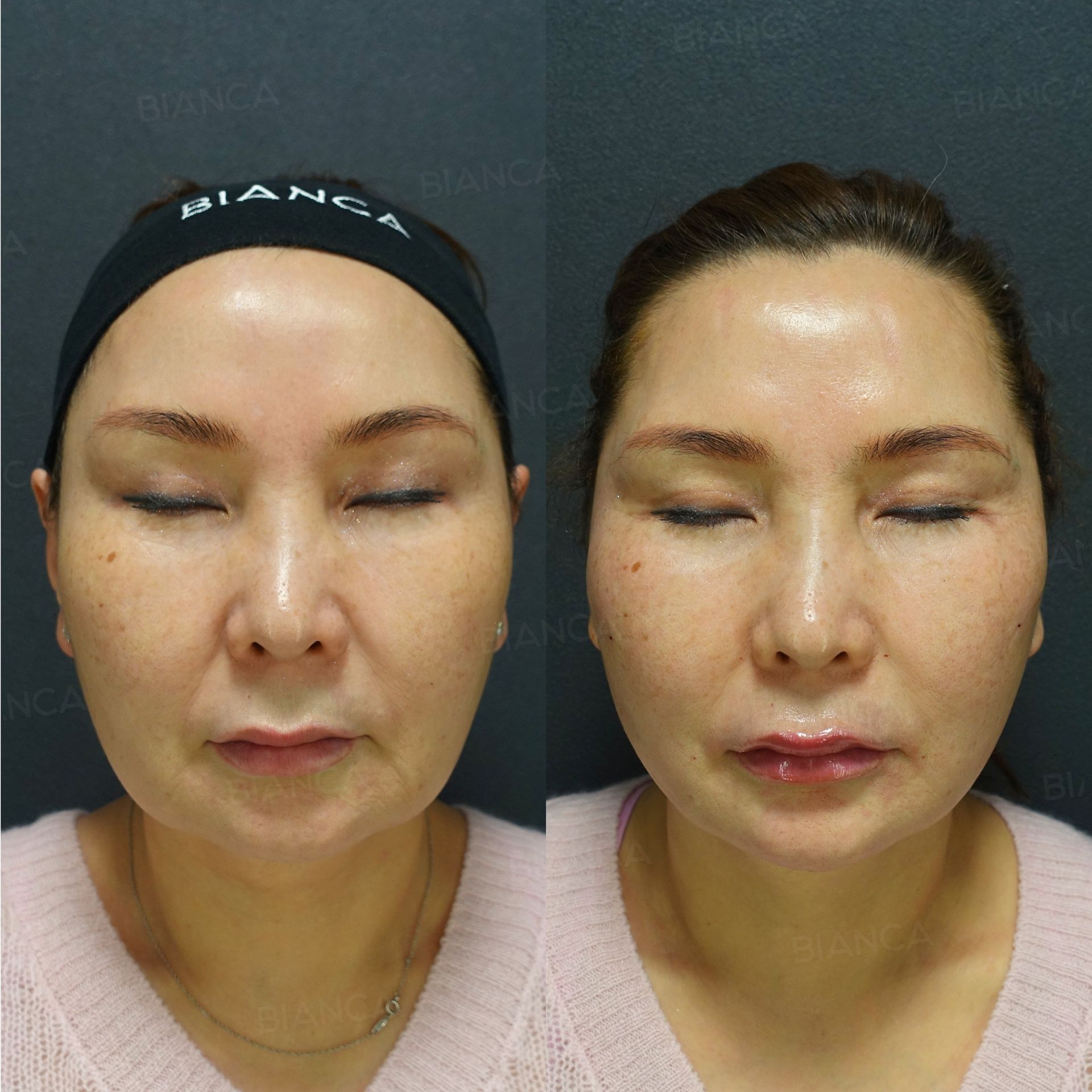 Thread lift before and after ARTEMIS threads placed to lift the cheek and jawline, front view, immediately after treatment