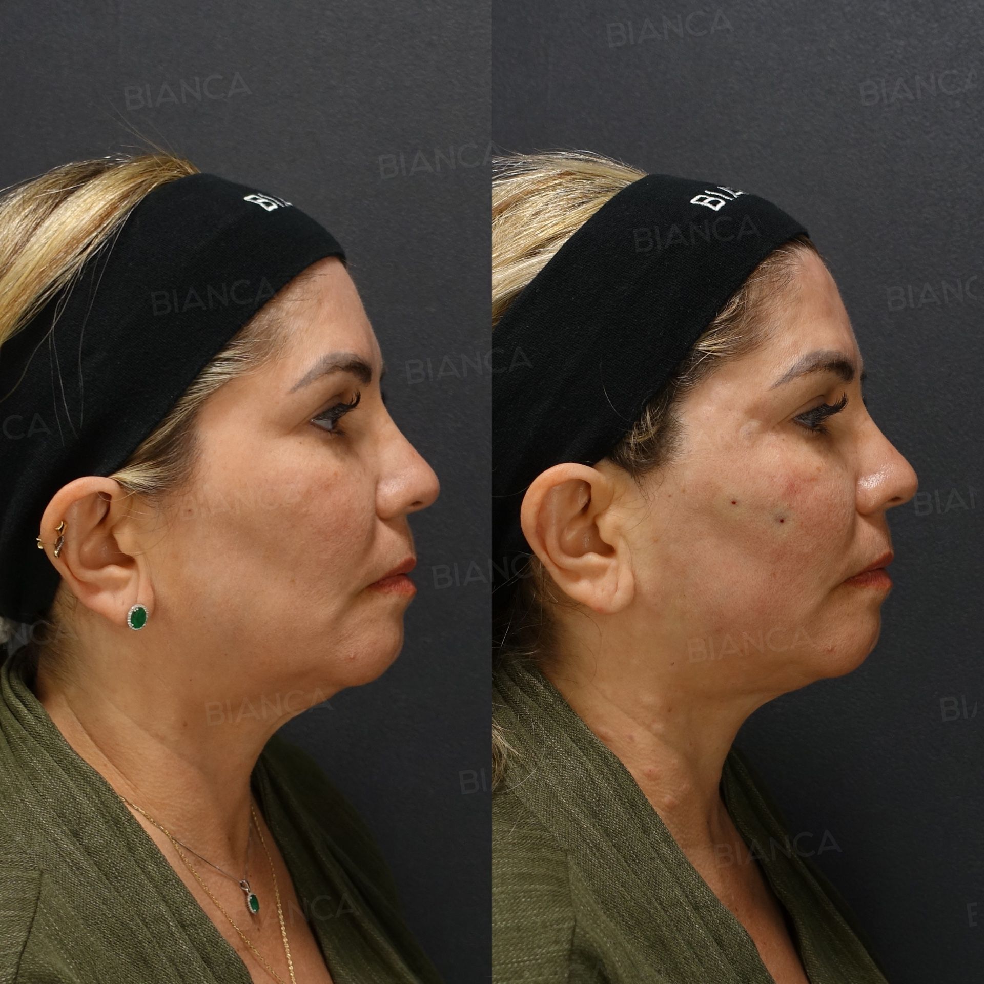 Thread lift before and after placement of absorbable ARTEMIS mesh threads, side view, immediately after treatment