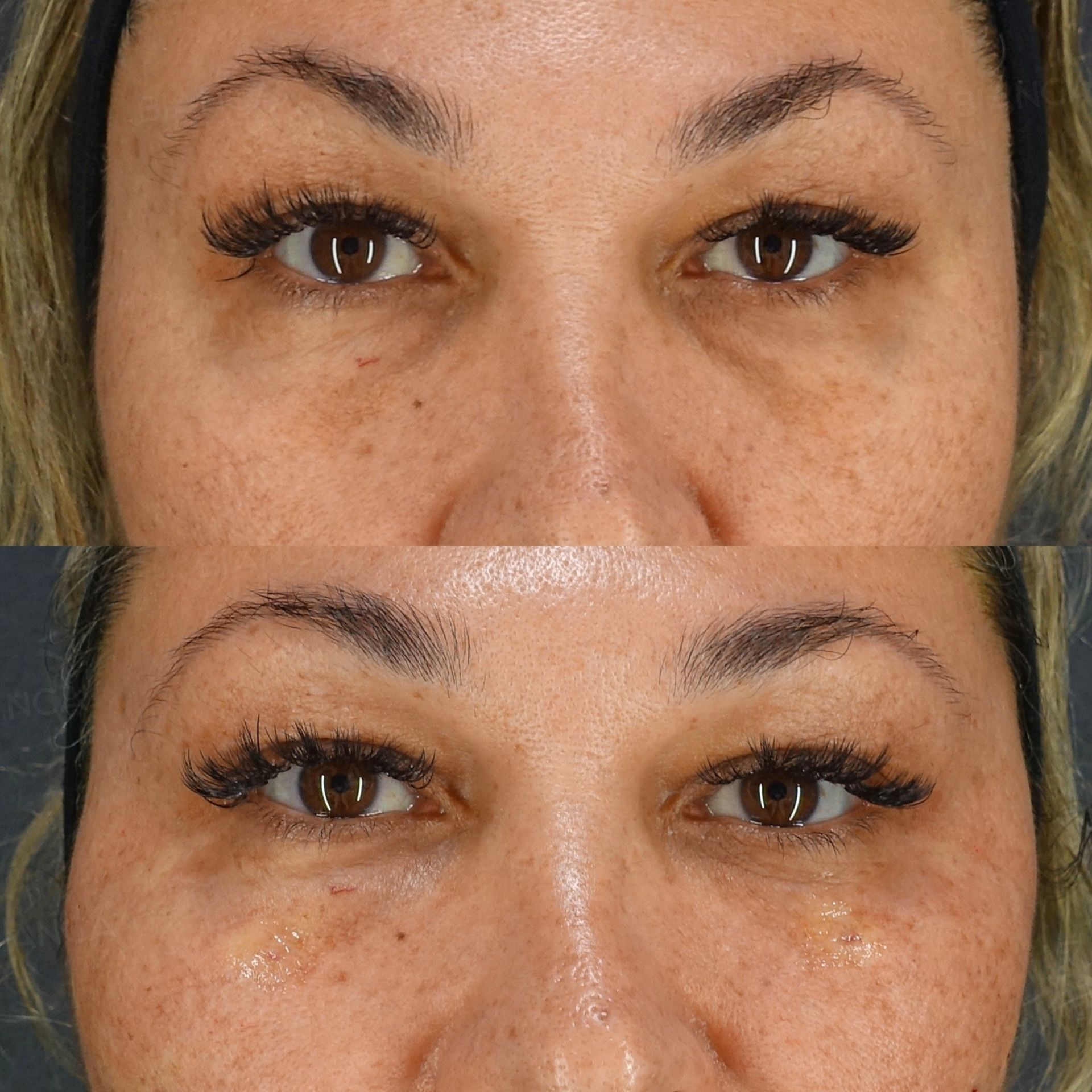 Thread Lift (ARTEMIS), Baby Collagen (Under Eyes)