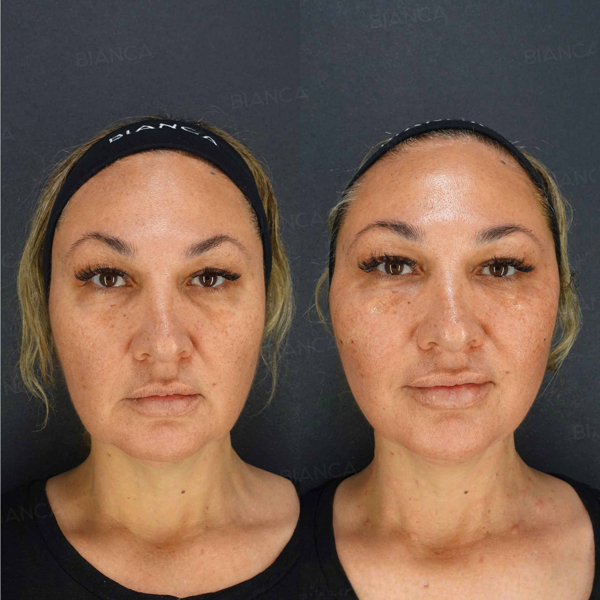 Thread lift before and after ARTEMIS threads lifting the sagging cheek with baby collagen under the eyes, front view of the face, immediately after treatment