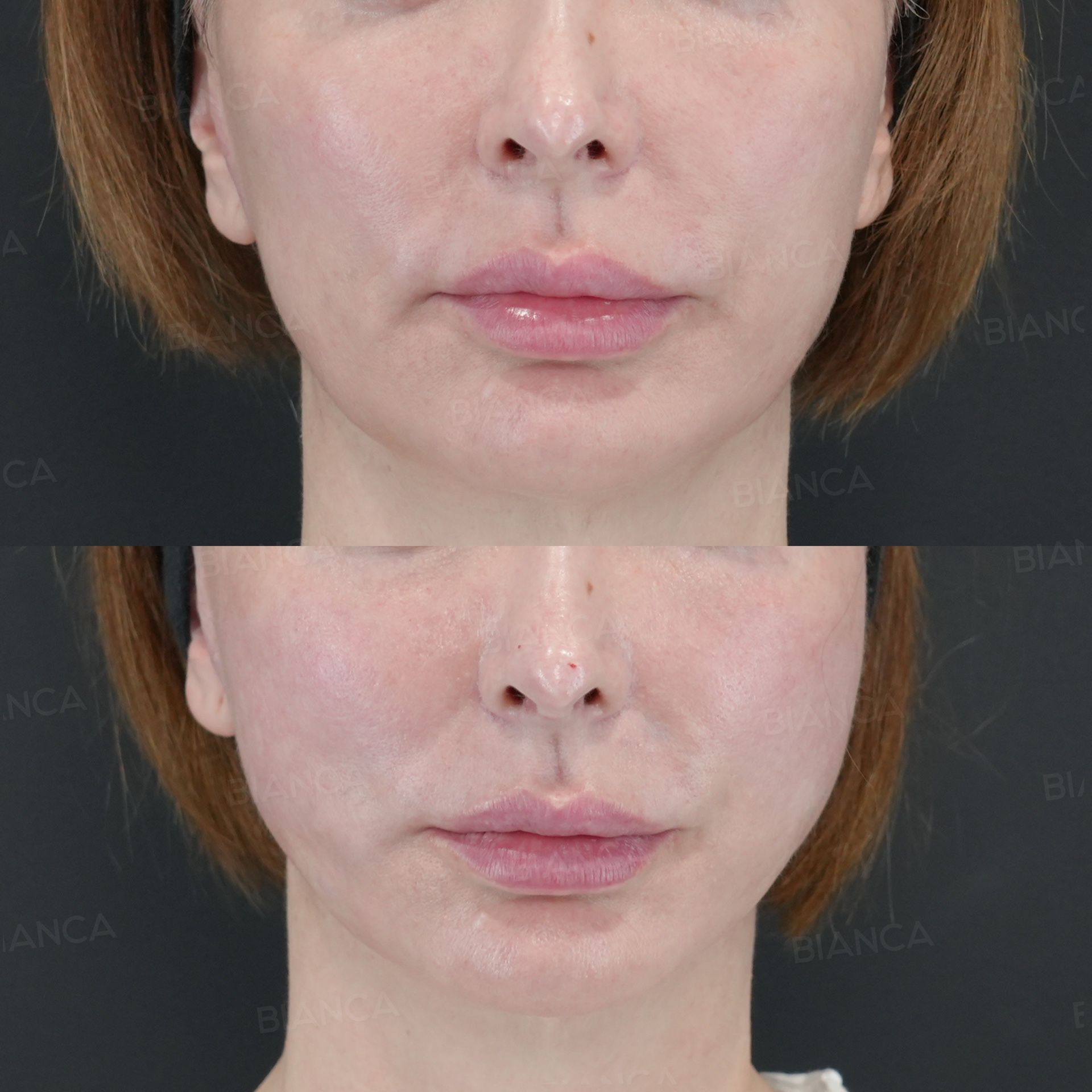 Thread lift before and after ARTEMIS LIFT with 10 absorbable threads repositioning sagging tissue in the lower face, front view at 3 weeks
