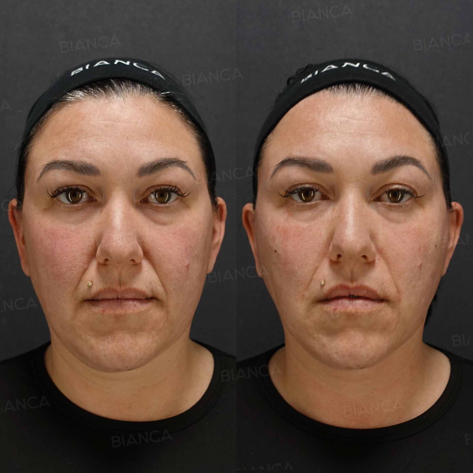 Thread lift before and after ARTEMIS LIFT threads in the cheek with Teosyal RHA 3 in the nasolabial folds, front view, immediately after treatment