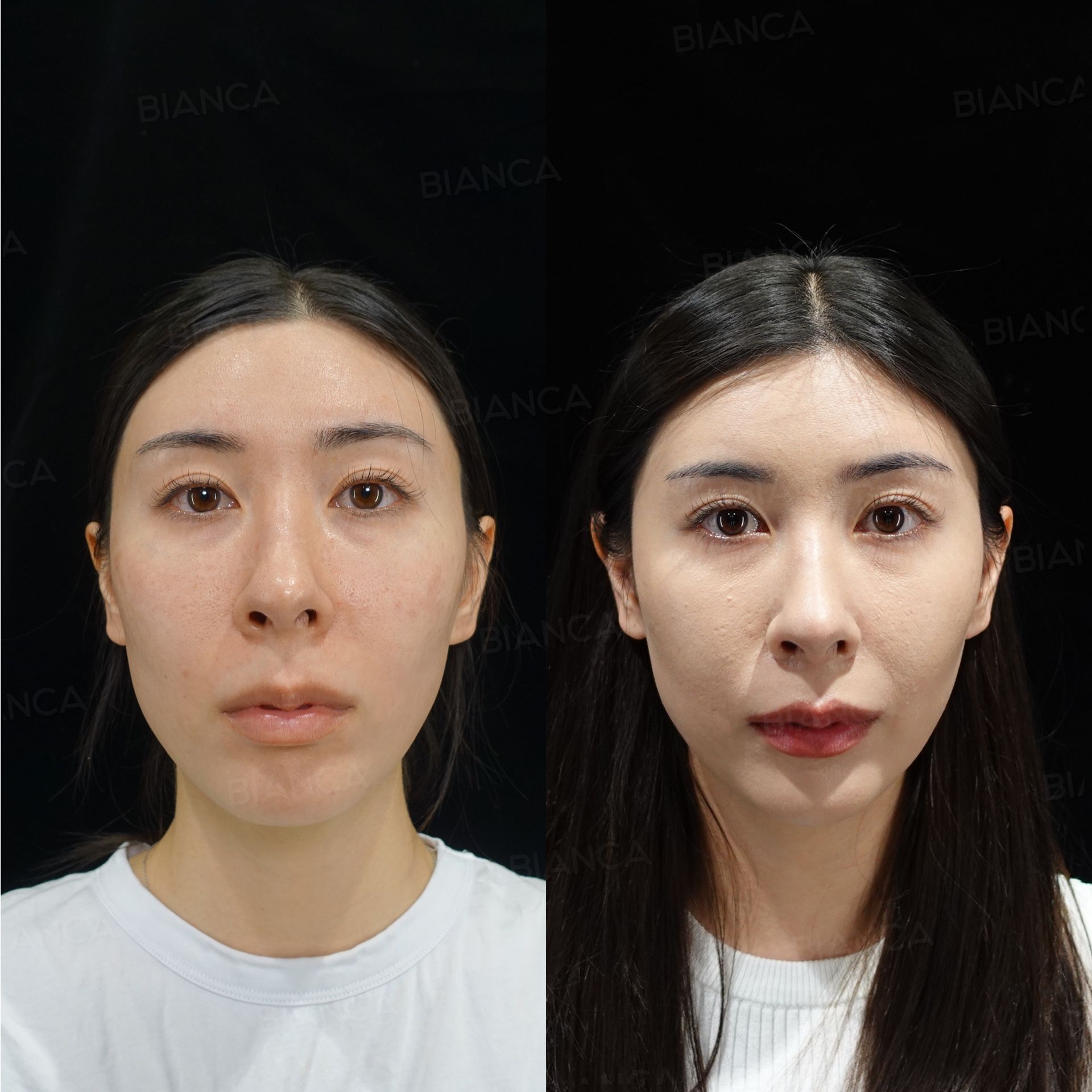 Thread lift before and after placement of ARTEMIS LIFT SHORT threads to support a localised area of sagging, front view at 2 weeks