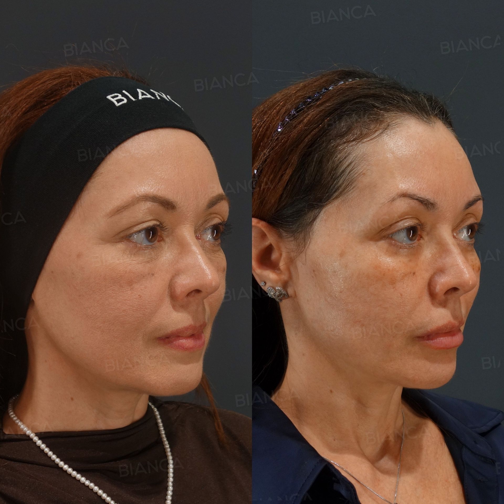 Thread lift before and after six BIANCA LIFT threads placed to support the cheek and the jaw border, three-quarter view at 1 month