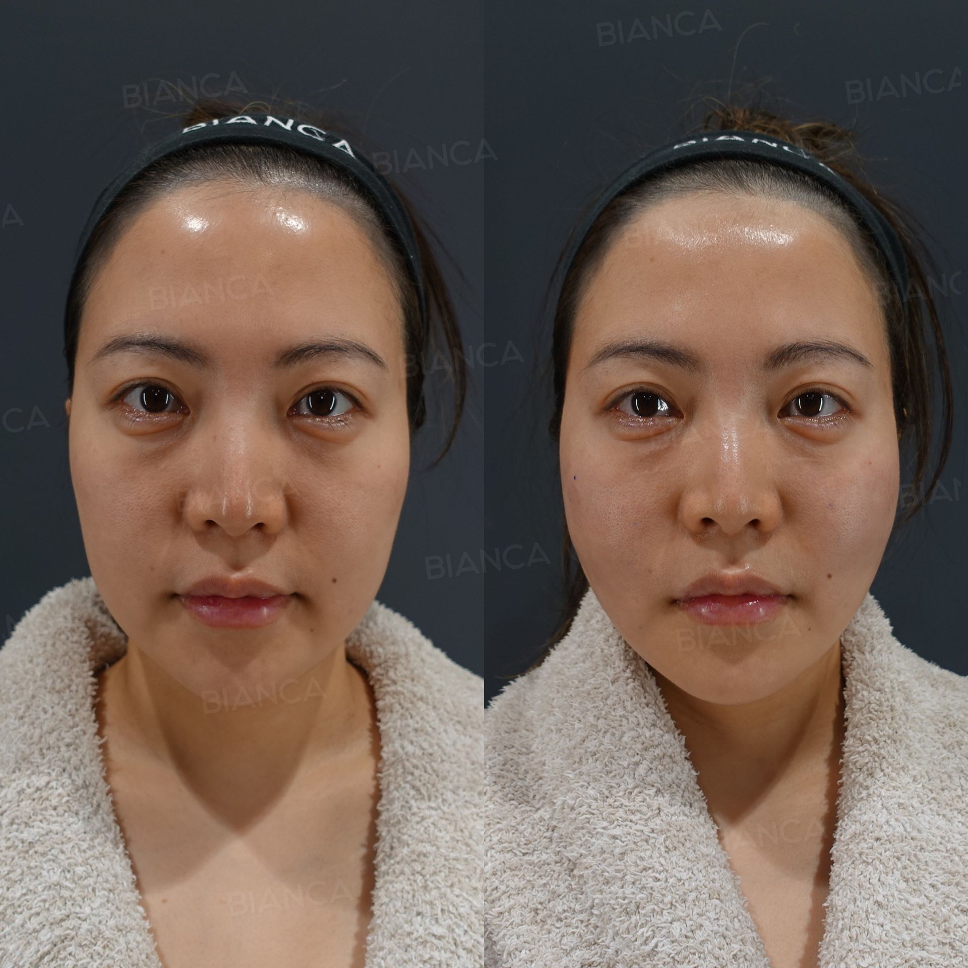 Thread lift before and after BIANCA LIFT threads anchored along the direction of tissue descent, front view, immediately after treatment