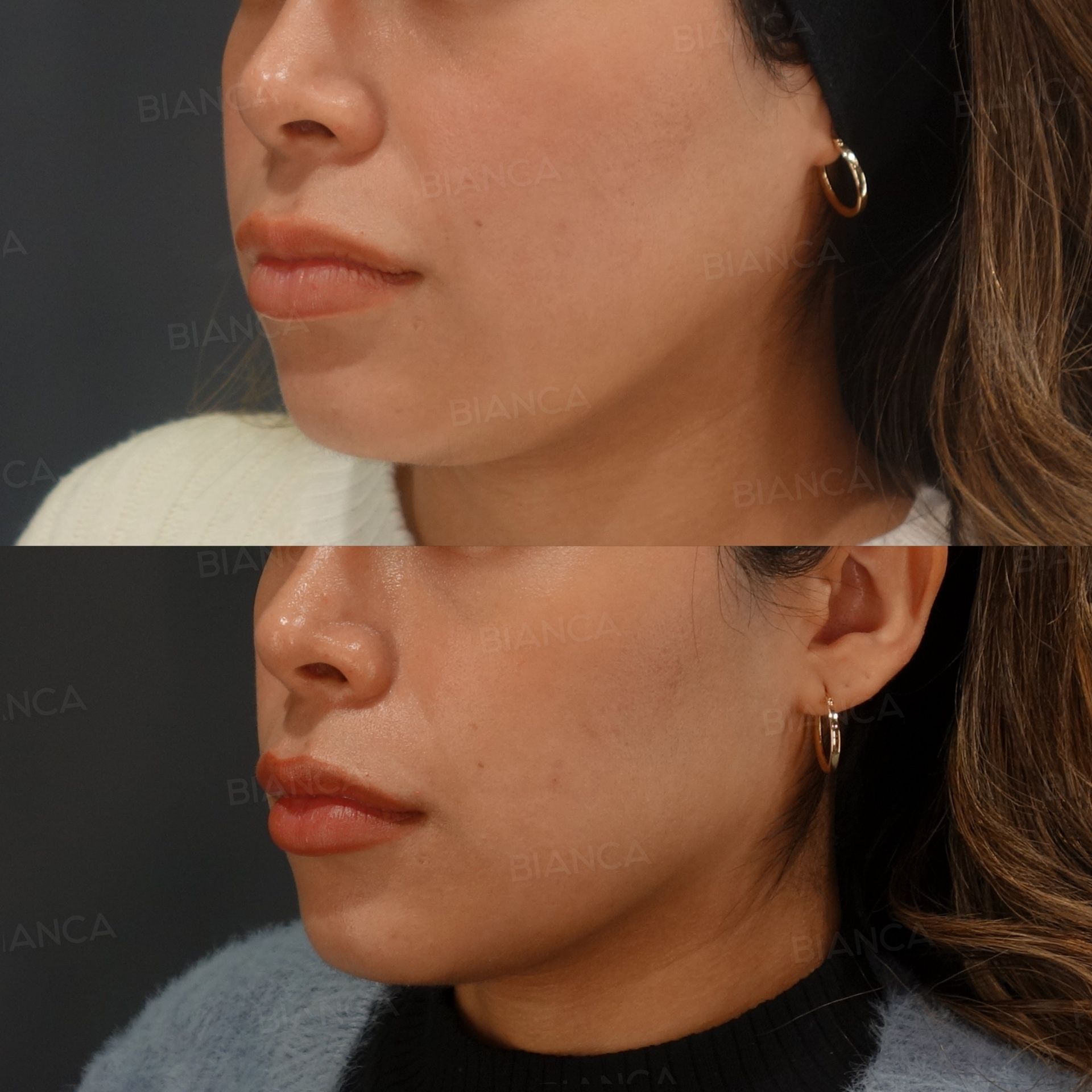 Thread lift before and after six BIANCA LIFT threads lifting the lower cheek and sharpening the jaw border, three-quarter view, at 2 weeks