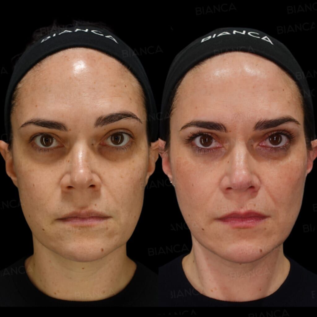 Thread Lift (BIANCA LIFT), Hyaluronic Acid Injection (Nasolabial Folds, Hollow Cheeks: Teosyal RHA 3, Restylane Lyft), Baby Collagen (Under Eyes)