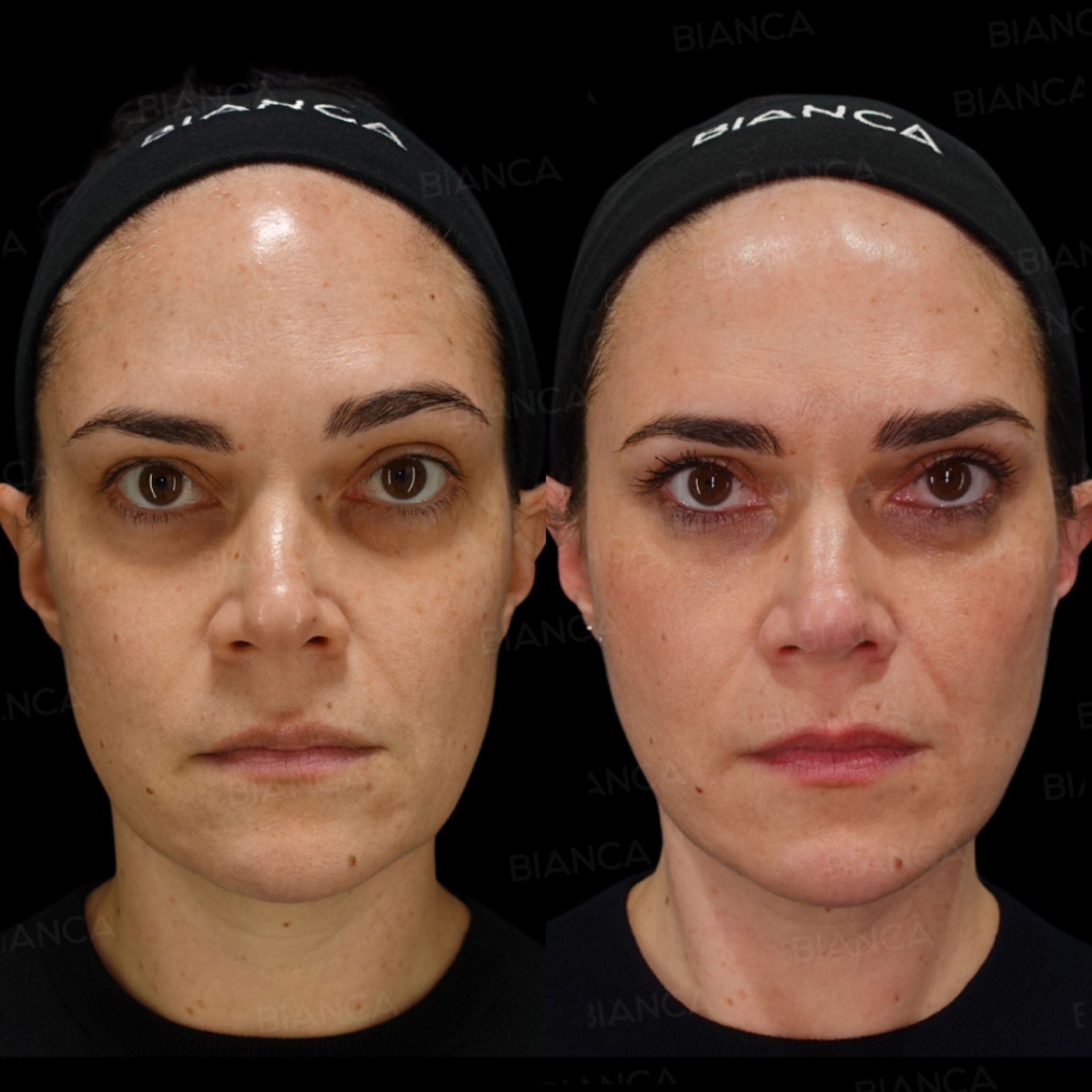 Thread Lift (BIANCA LIFT), Hyaluronic Acid Injection (Nasolabial Folds, Hollow Cheeks: Teosyal RHA 3, Restylane Lyft), Baby Collagen (Under Eyes)