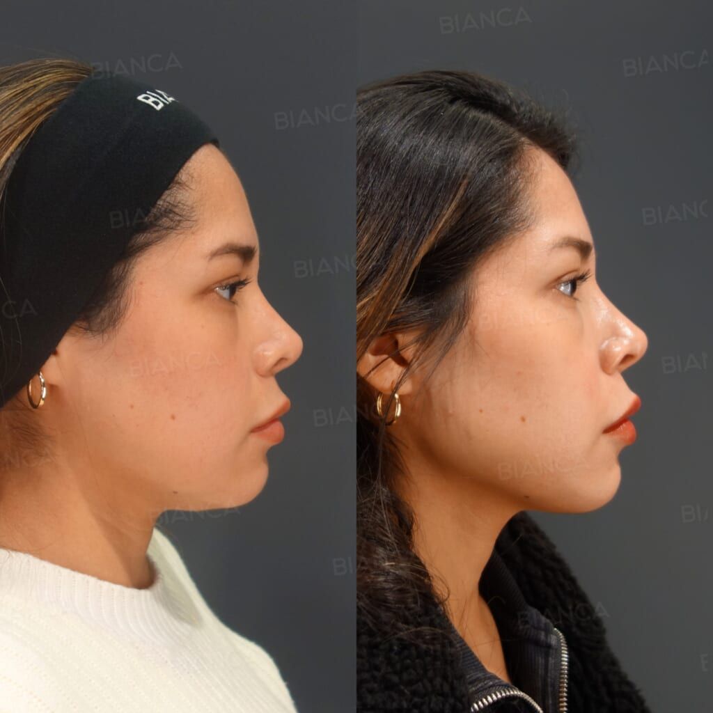 Thread Lift, Hyaluronic Acid Injection, Botox Injection