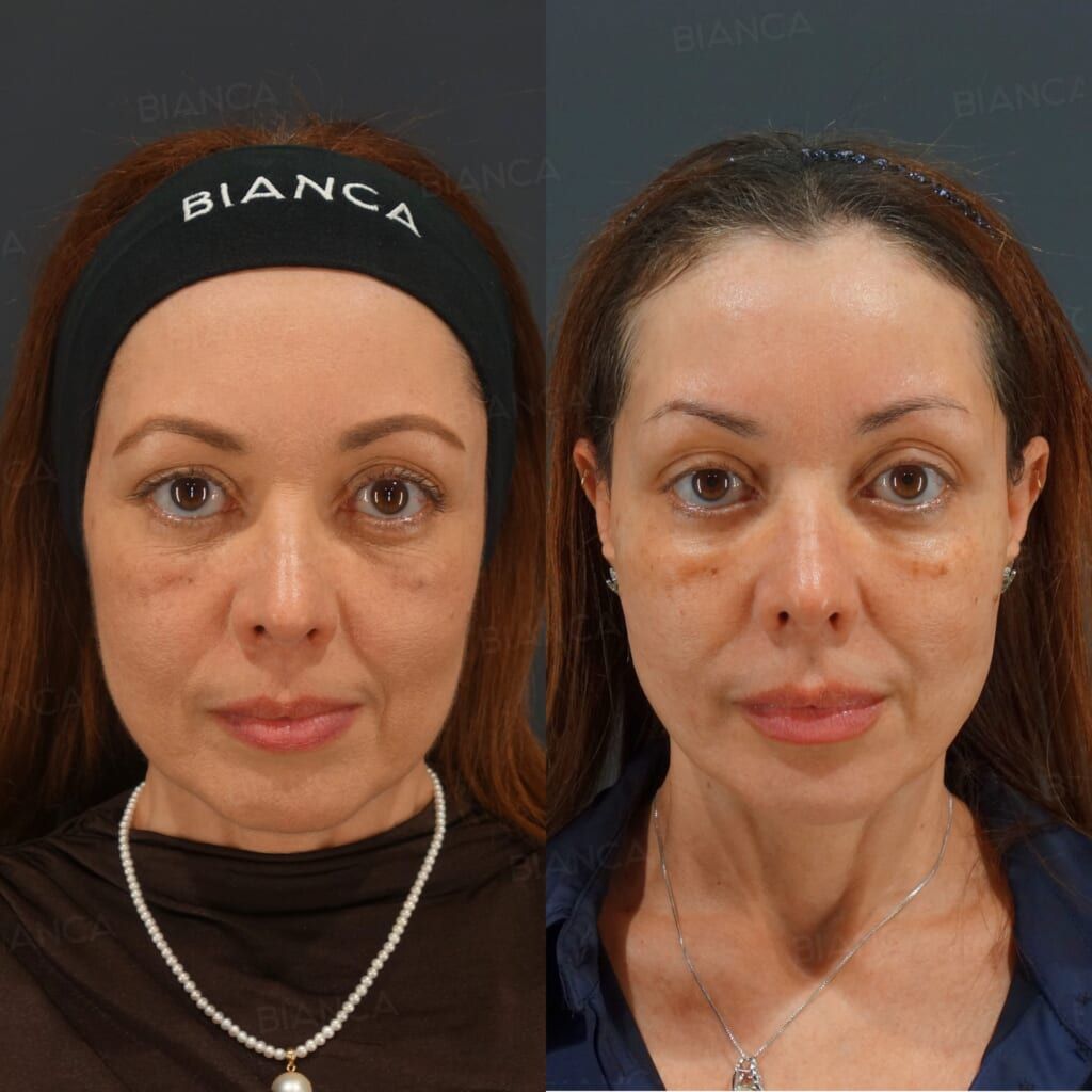Thread Lift, Hyaluronic Acid Injection, Botox Injection